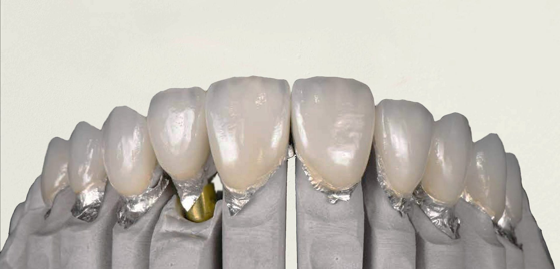 Do Veneers Damage Your Teeth? Dr. Fabbro, Italian cosmetic and restorative dentist, Jumeirah, Dubai