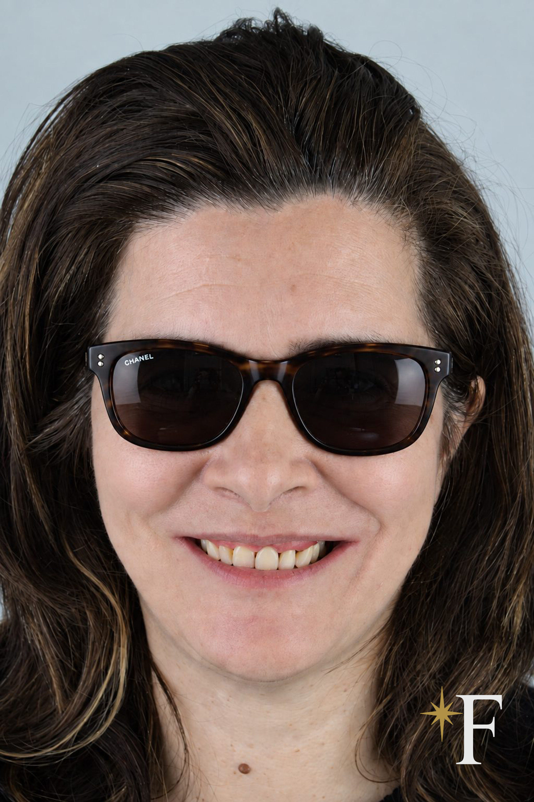 Before cosmetic dentistry treatment in Dubai, same lens and position