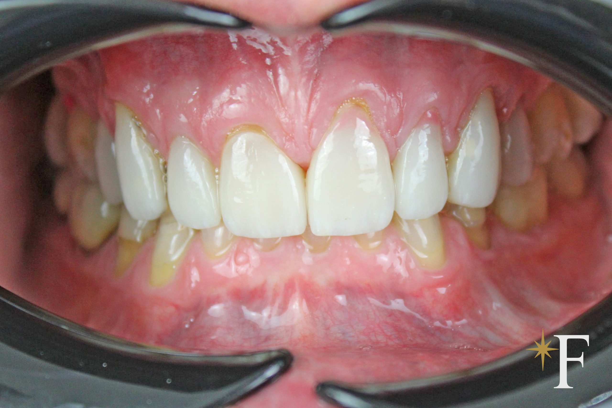 Eight failing veneers before replacement: flat opaque ceramic and a shadowed margin at the gum, Dr. Fabbro, Dubai