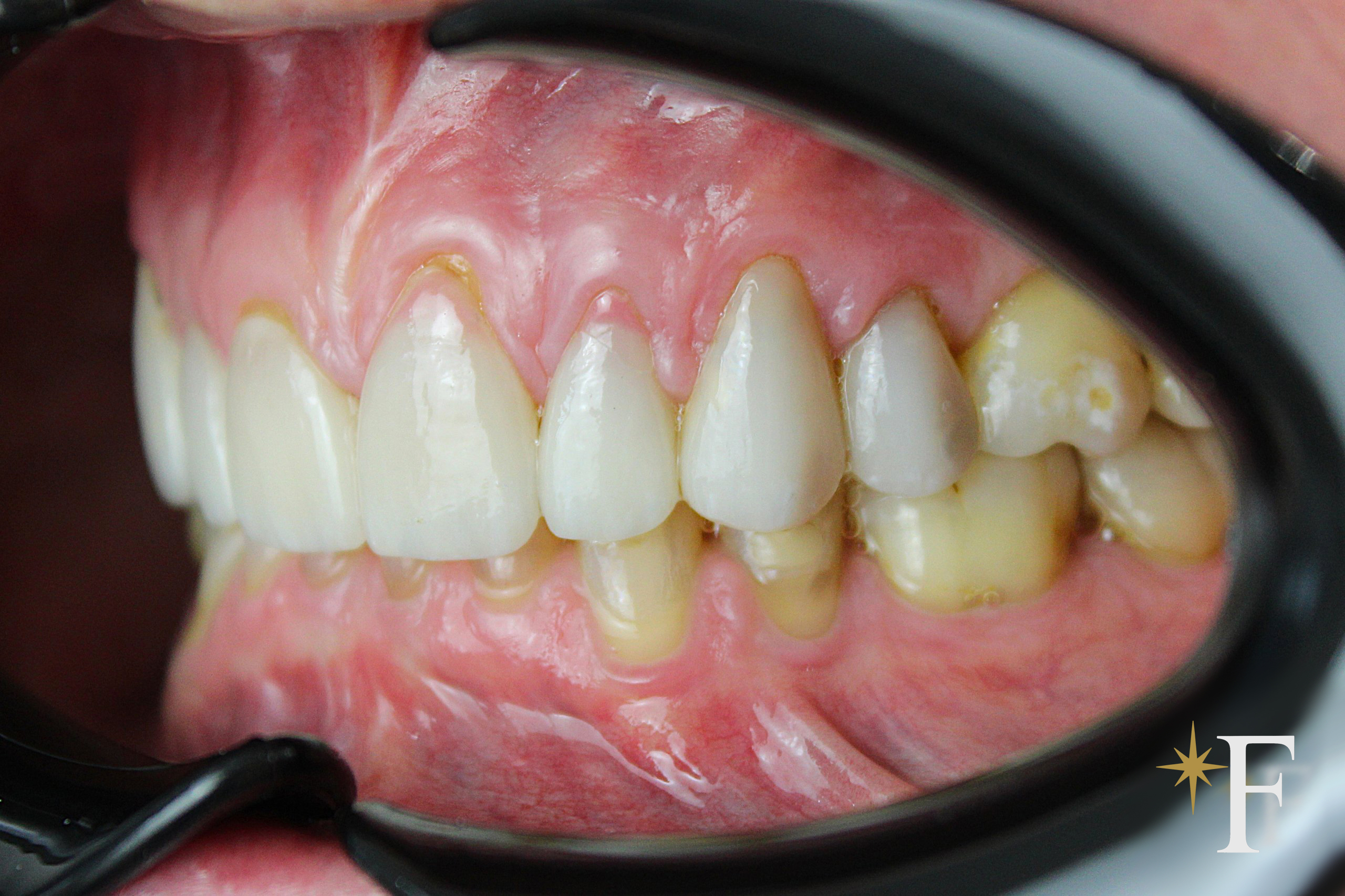 Failing veneers from the side: the step where the restoration ends and the natural tooth begins, Dr. Fabbro, Dubai