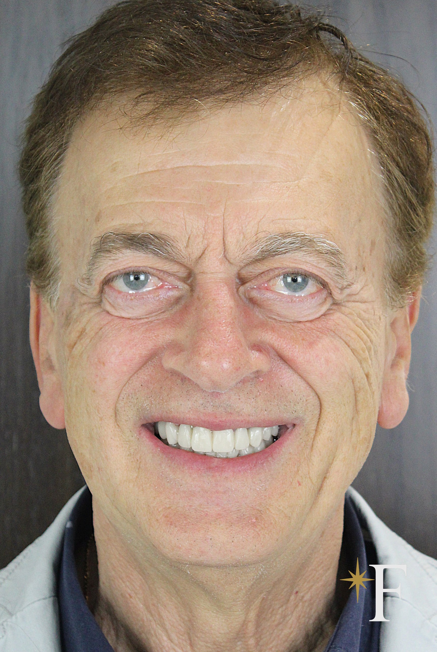 After veneers in Dubai, case 7, full face, same lens and position