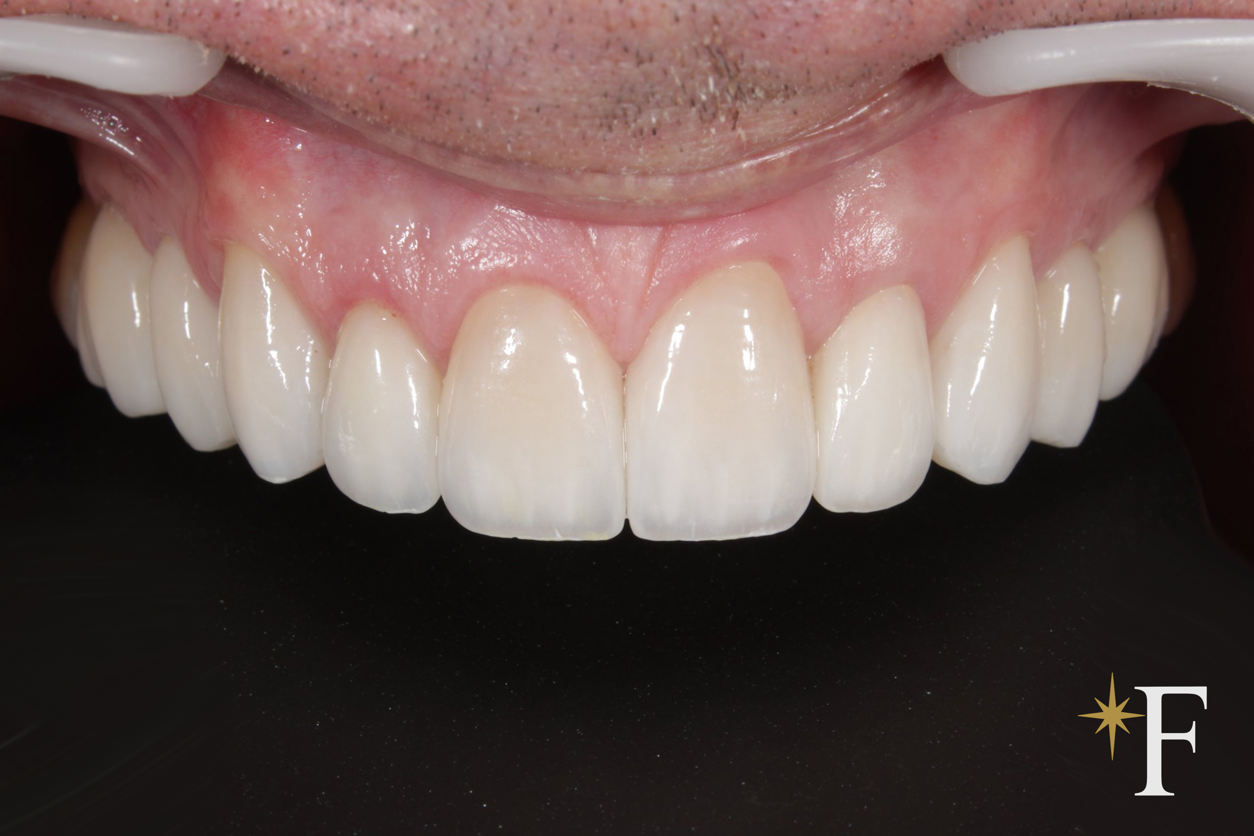 The replacement veneers in place, front view, Dr. Fabbro, Dubai