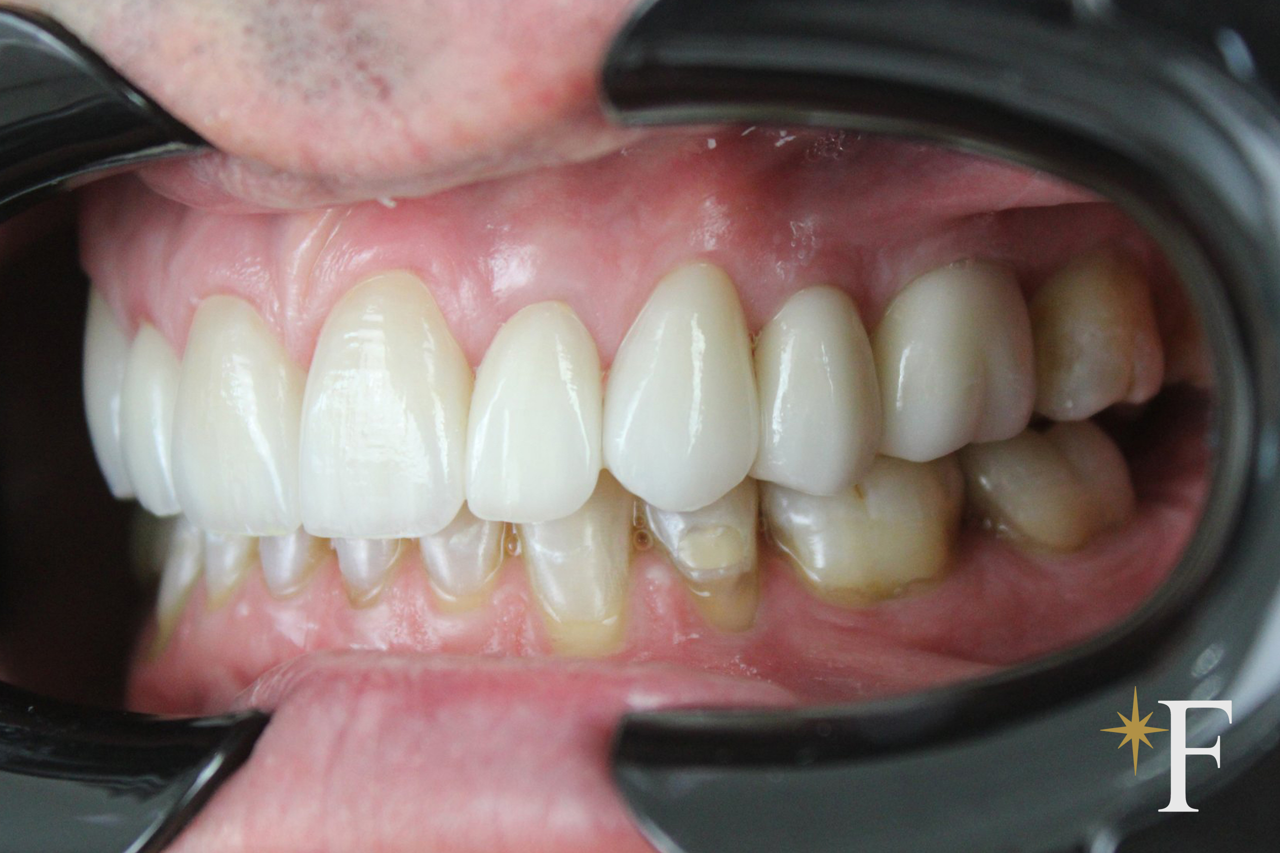 The replacement veneers from the side, the transition to natural tooth, Dr. Fabbro, Dubai