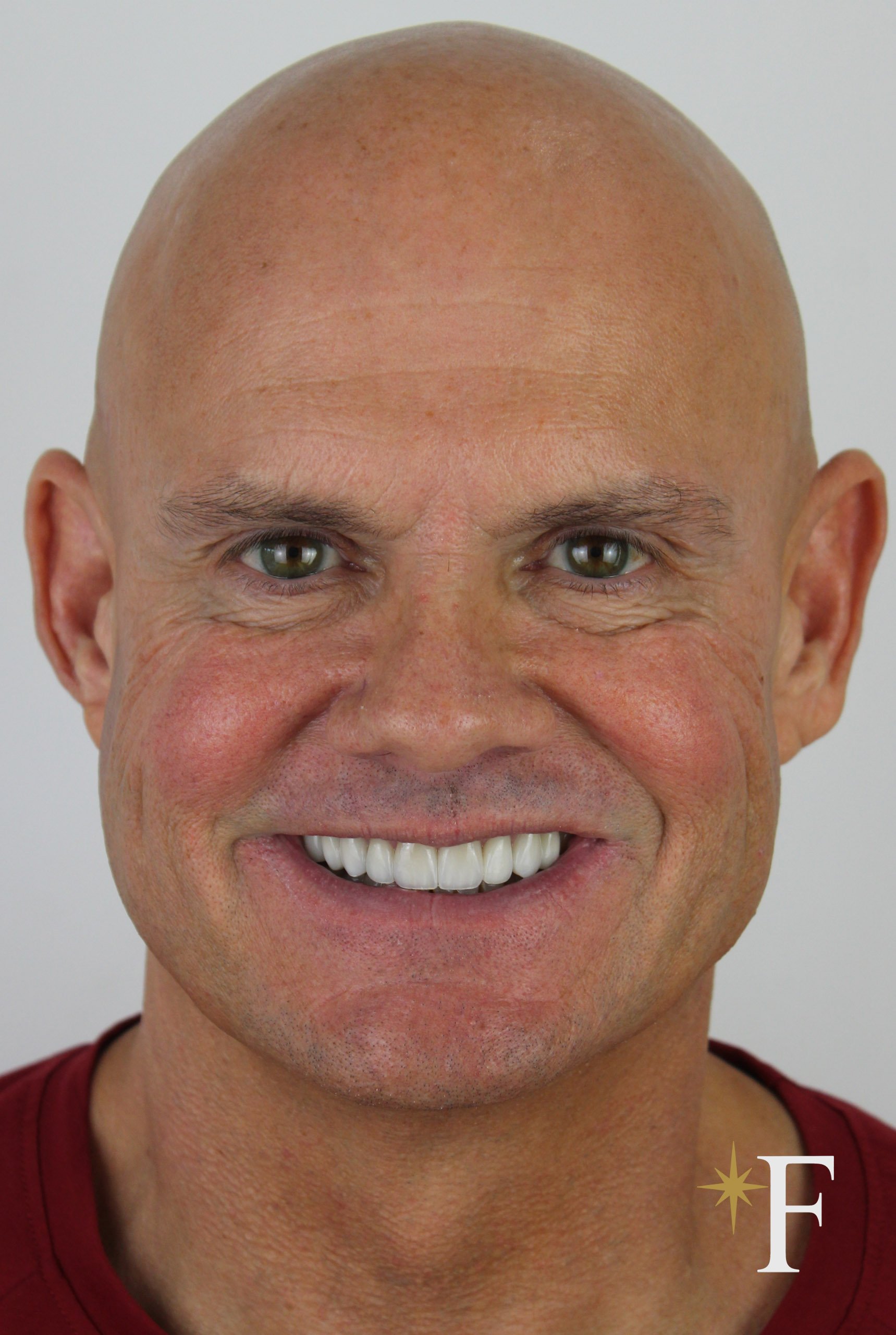 After veneers in Dubai, case 4, full face, same lens and position