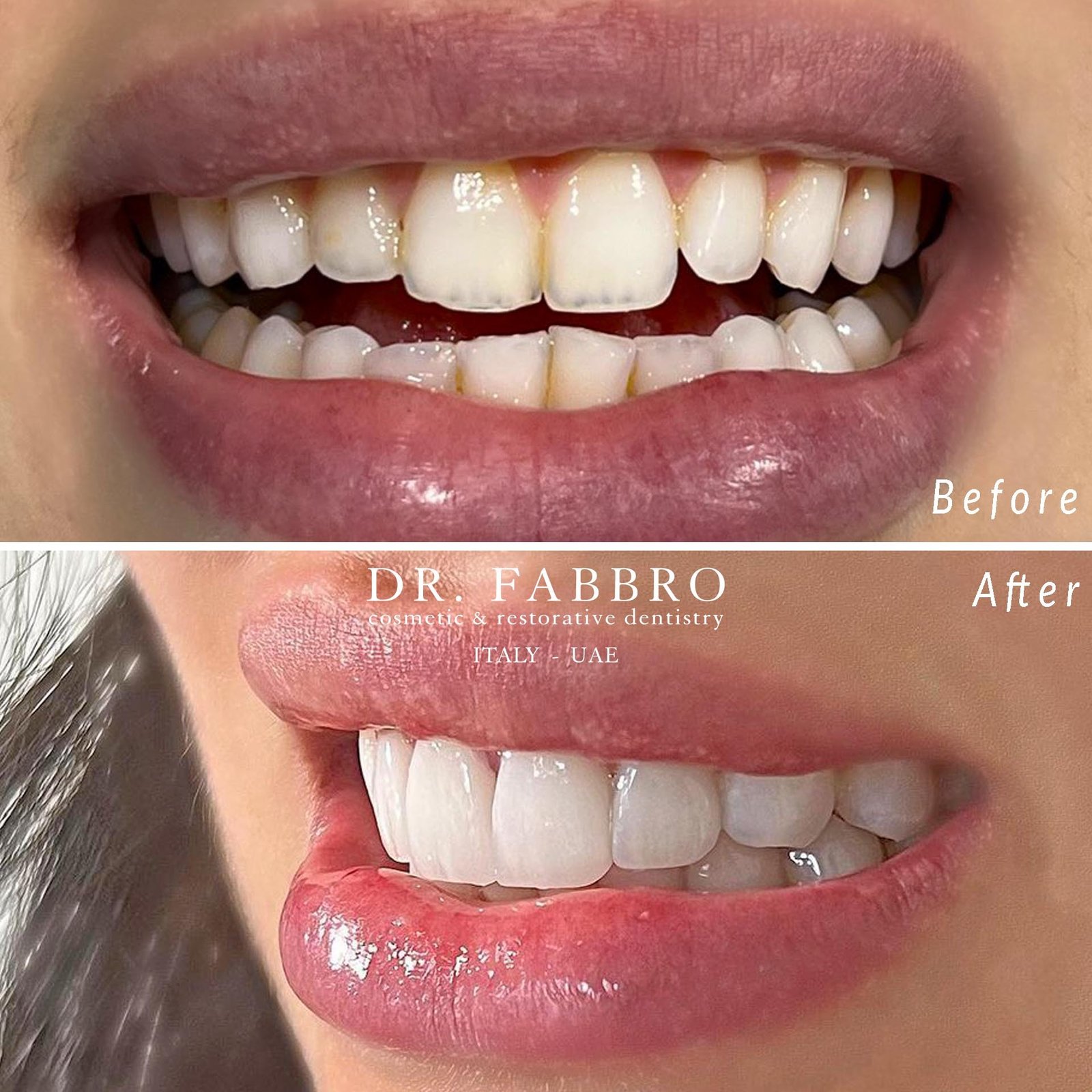 Ceramic veneers before and after, Dubai, case 4