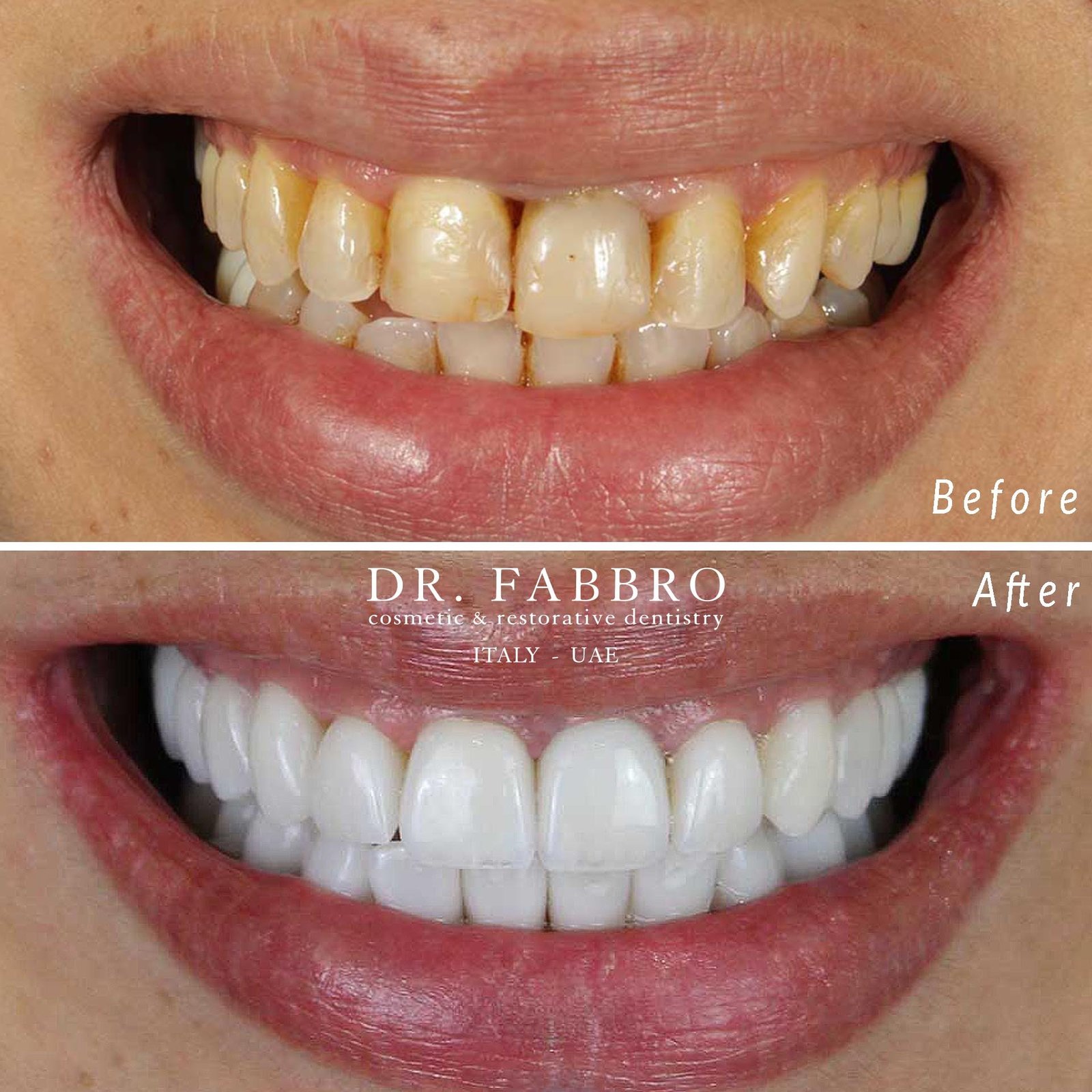 Ceramic veneers before and after, Dubai, case 5