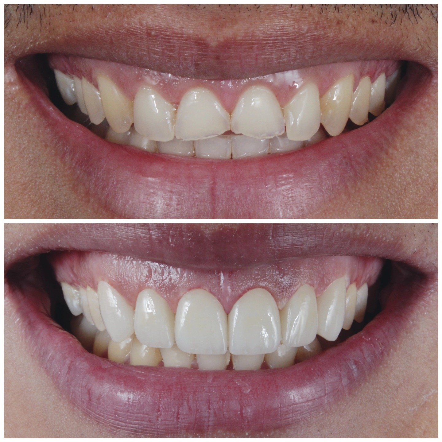 Ceramic veneers before and after, Dubai, case 7