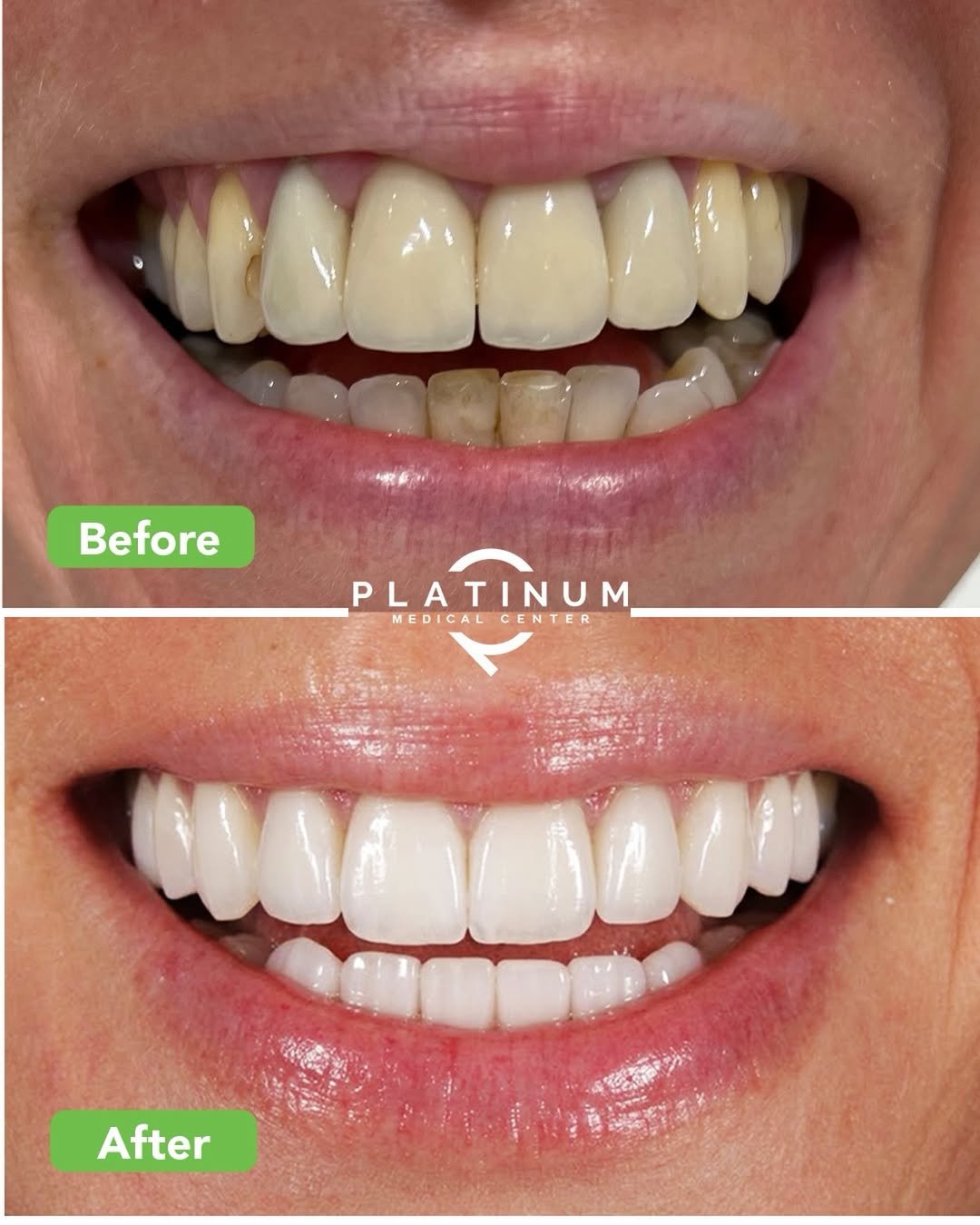 Ceramic veneers before and after, Dubai, case 8