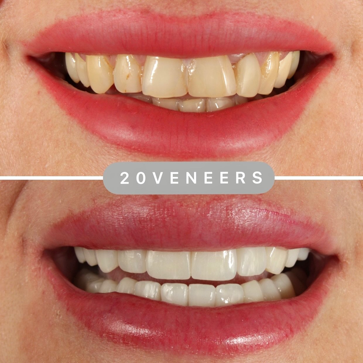 Ceramic veneers before and after, Dubai, case 10