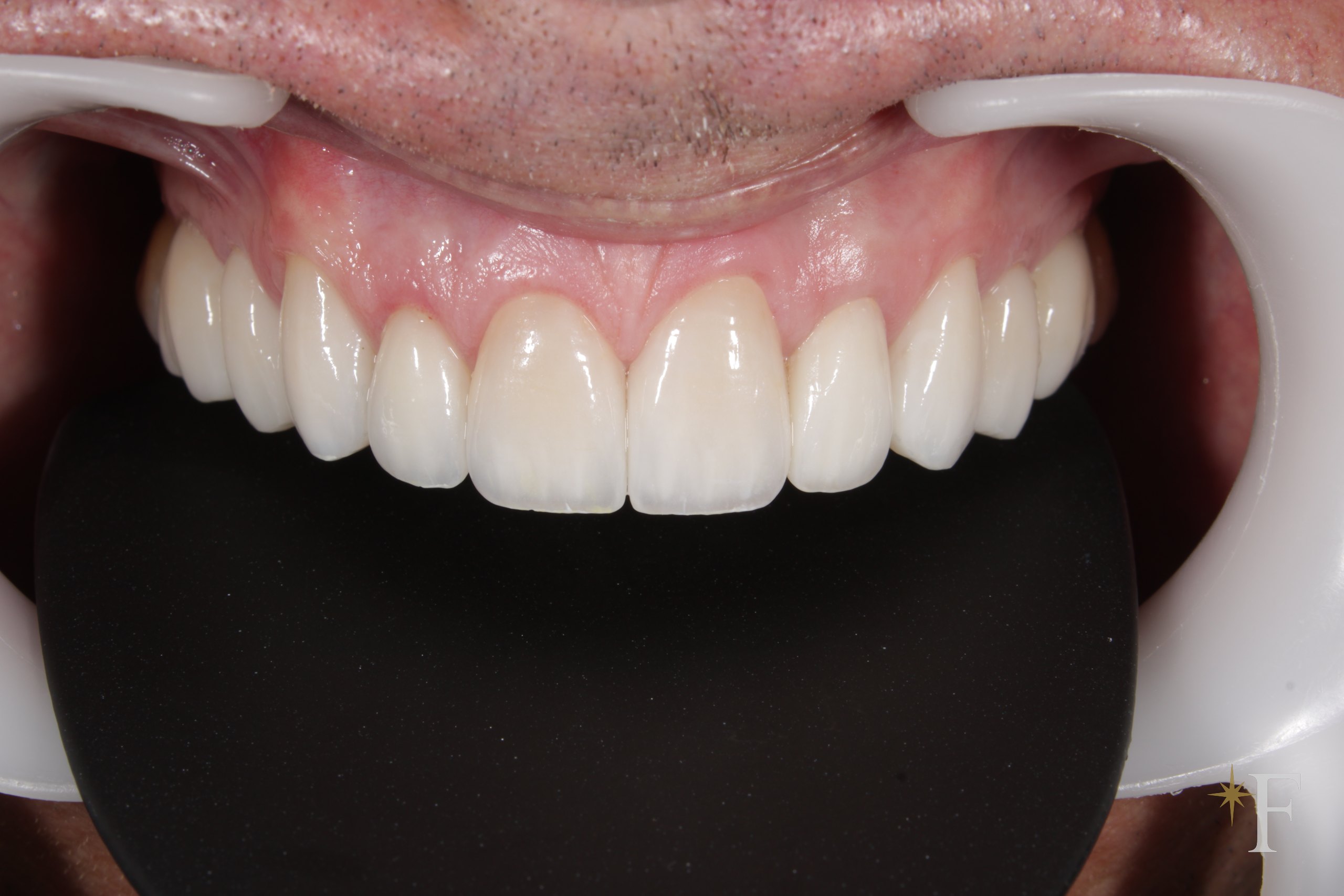 The replacement veneers in place, front view, Dr. Fabbro, Dubai
