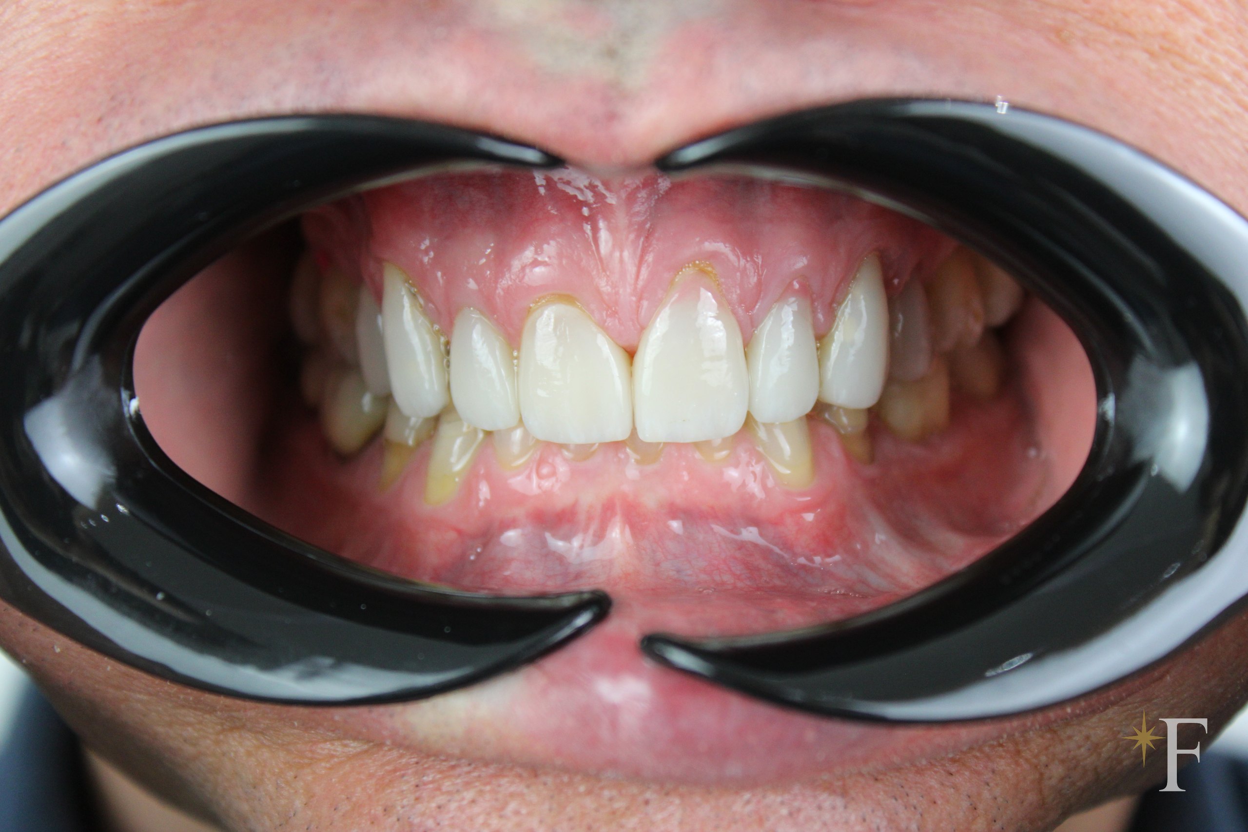 Eight failing veneers before replacement: flat opaque ceramic and a shadowed margin at the gum, Dr. Fabbro, Dubai