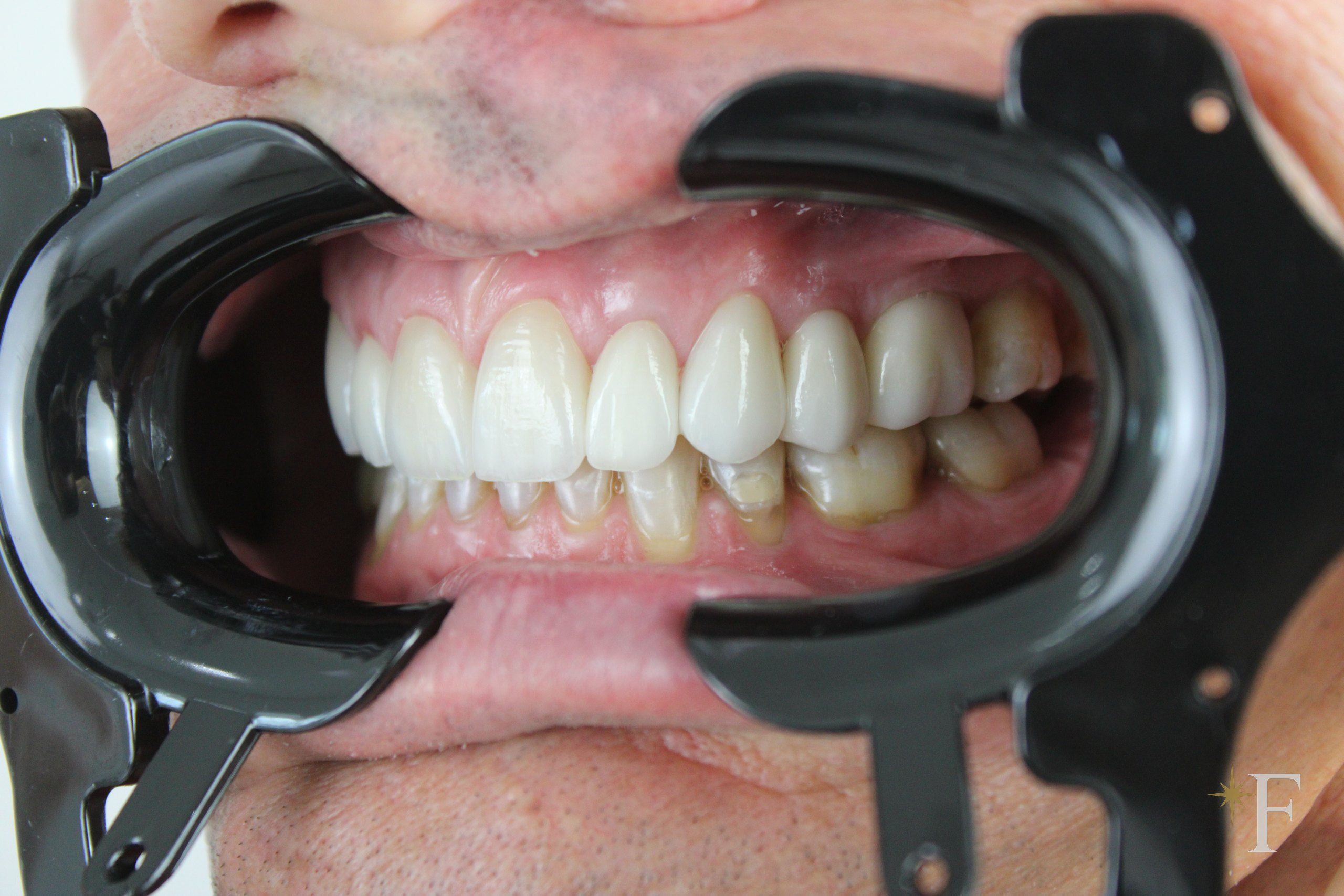The replacement veneers from the side, the transition to natural tooth, Dr. Fabbro, Dubai
