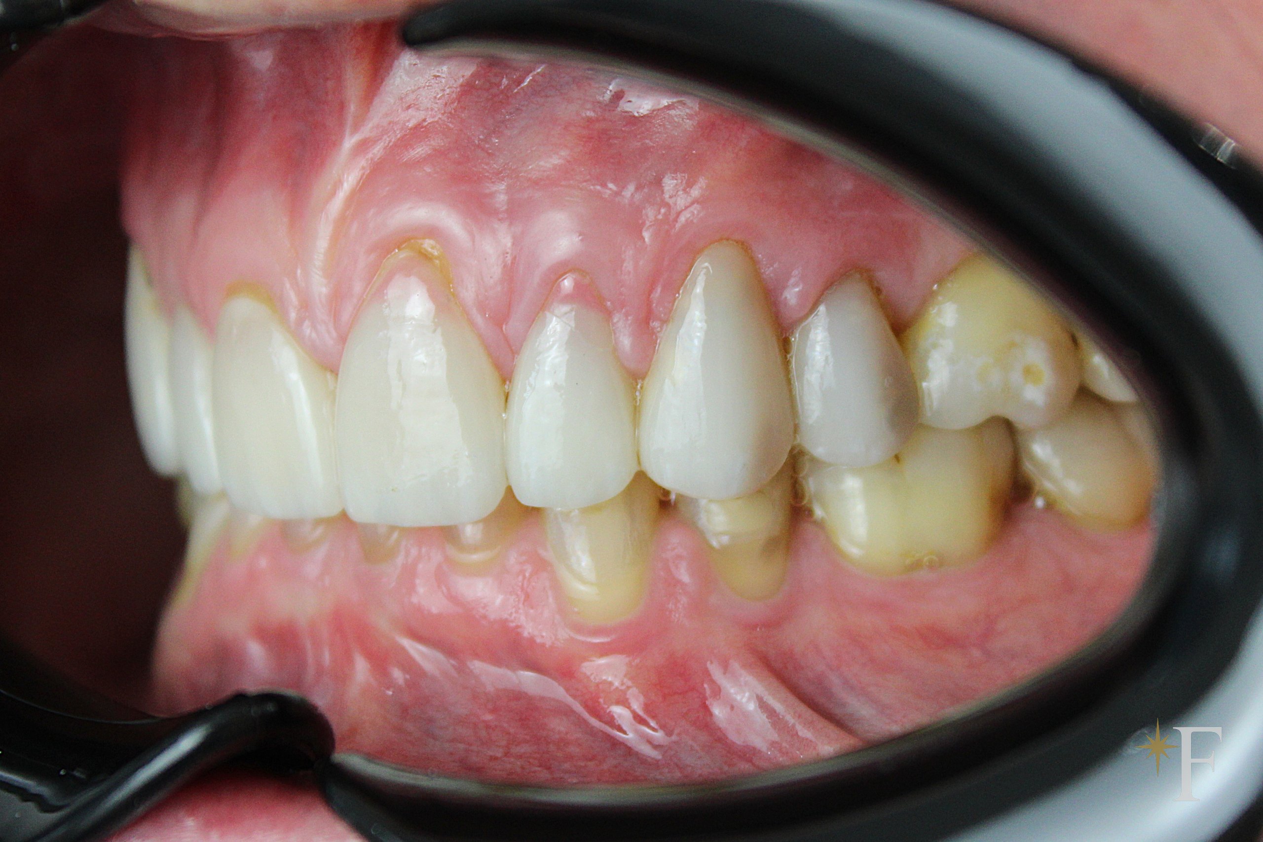 Failing veneers from the side: the step where the restoration ends and the natural tooth begins, Dr. Fabbro, Dubai