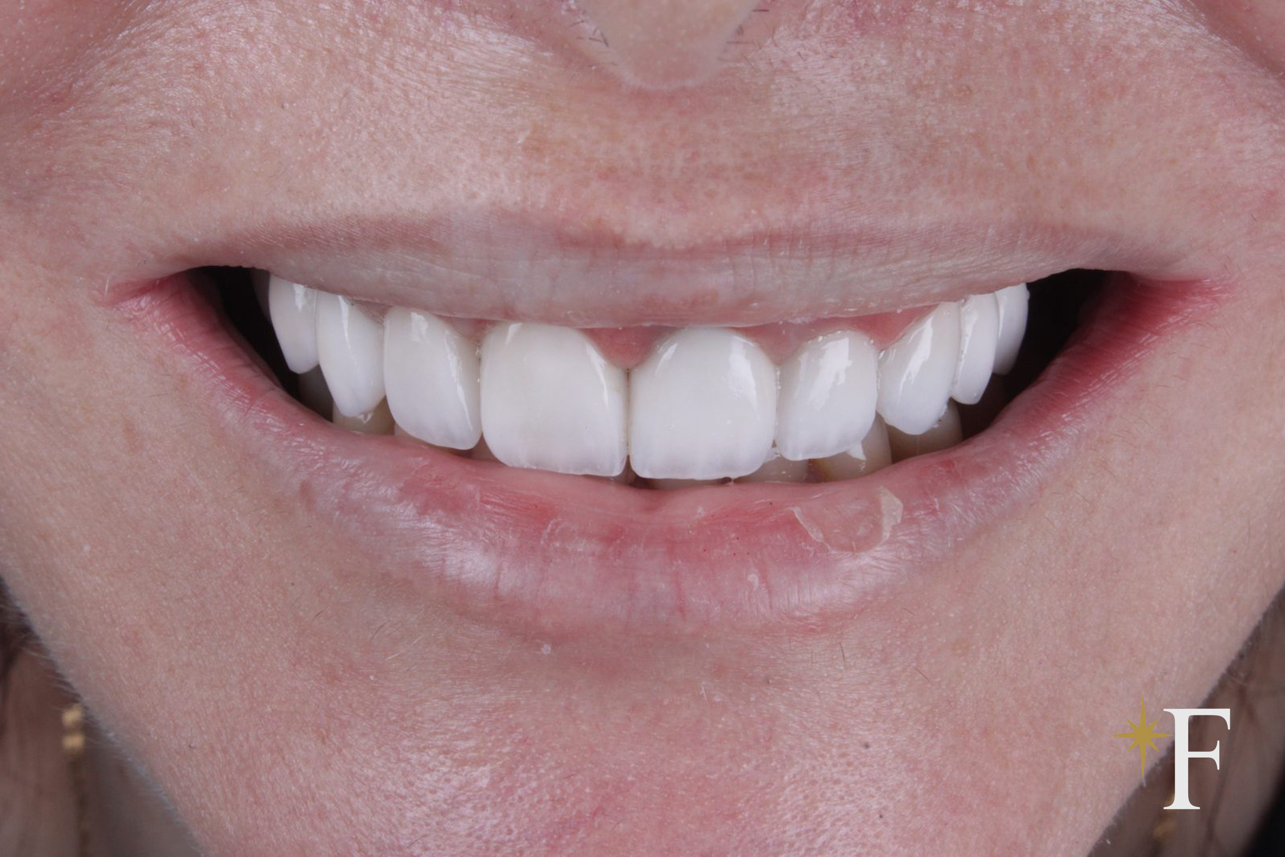 After full mouth rehabilitation in Dubai, identical framing and light