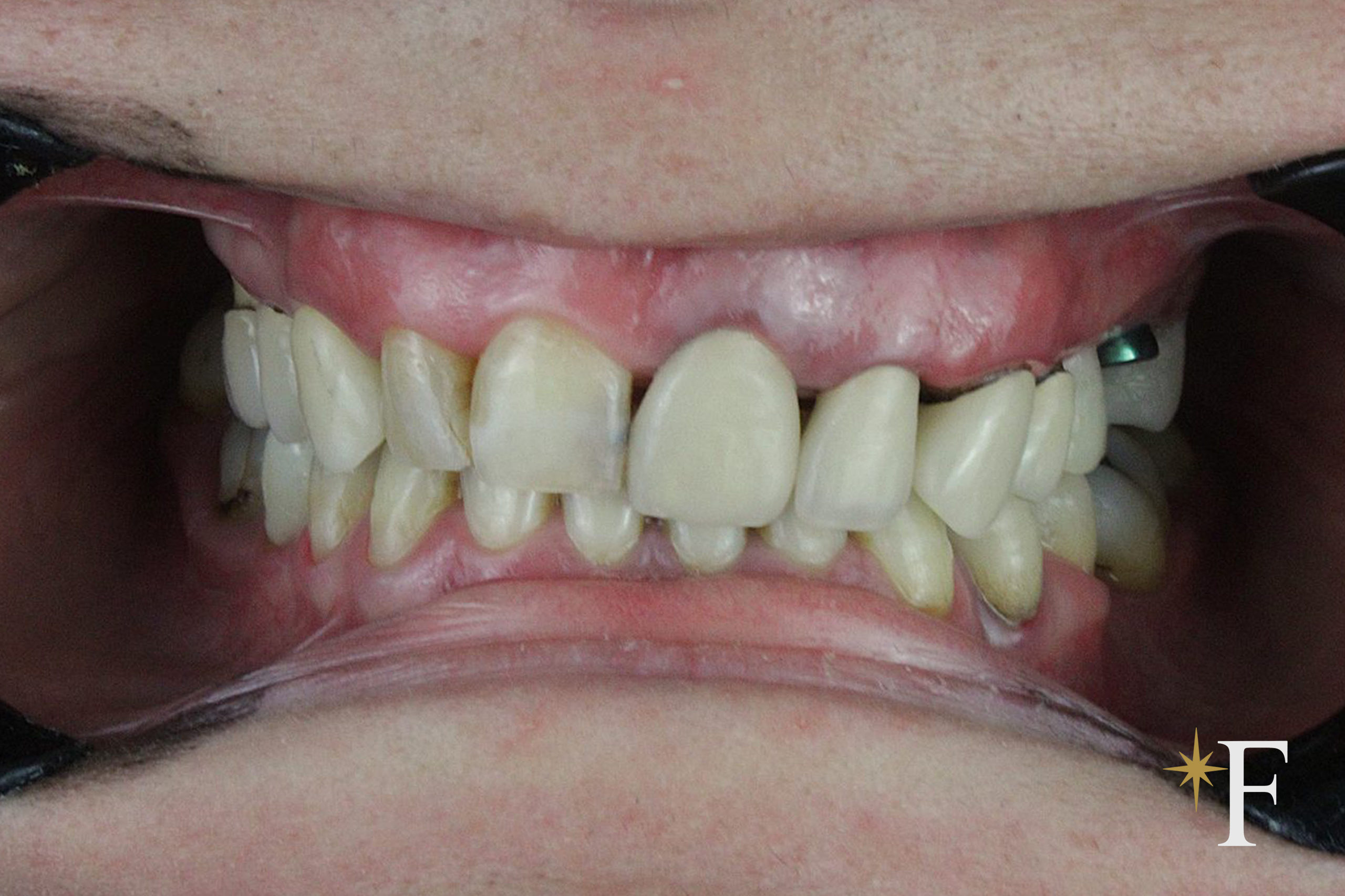 Before full mouth rehabilitation, photographed with the same lens