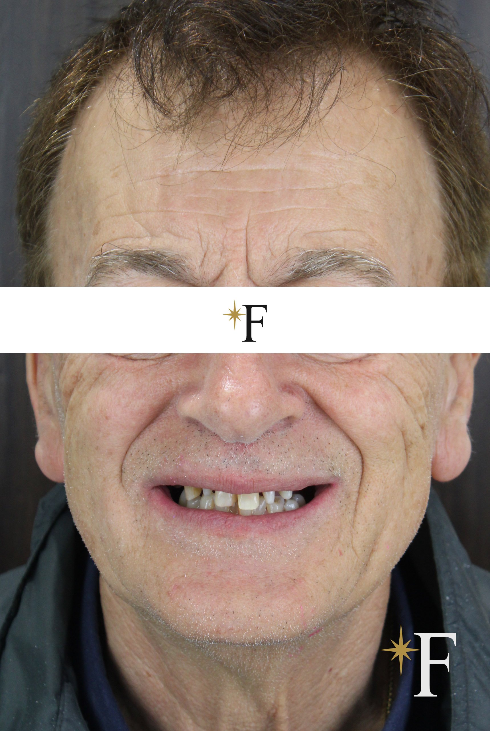 Before full mouth rehabilitation, Dr. Fabbro Dubai, consented patient case