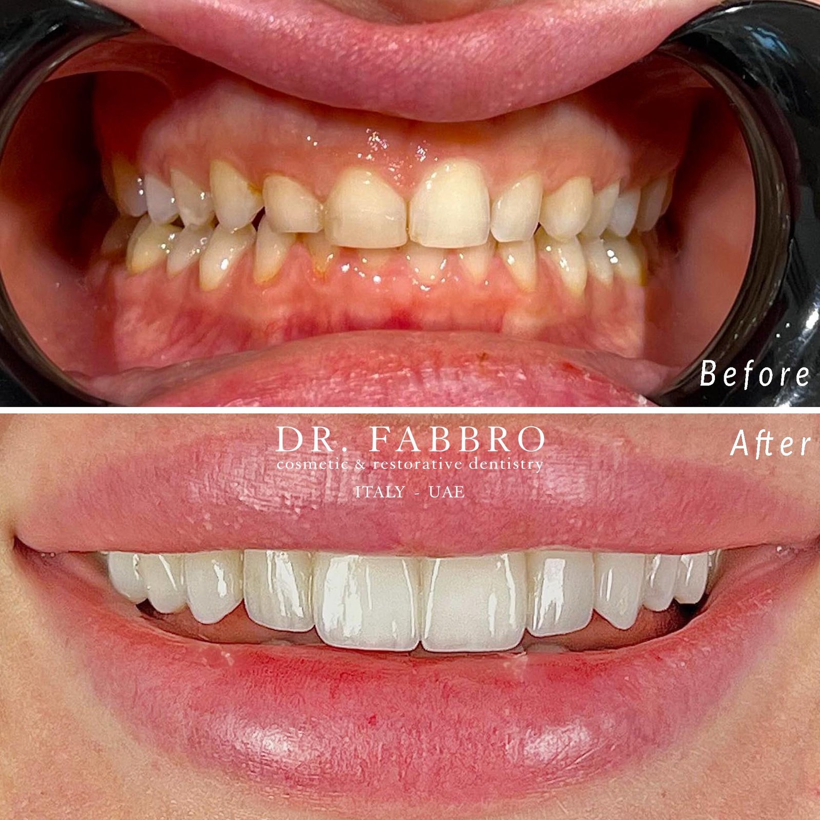 Ceramic veneers before and after, Dubai, case 1