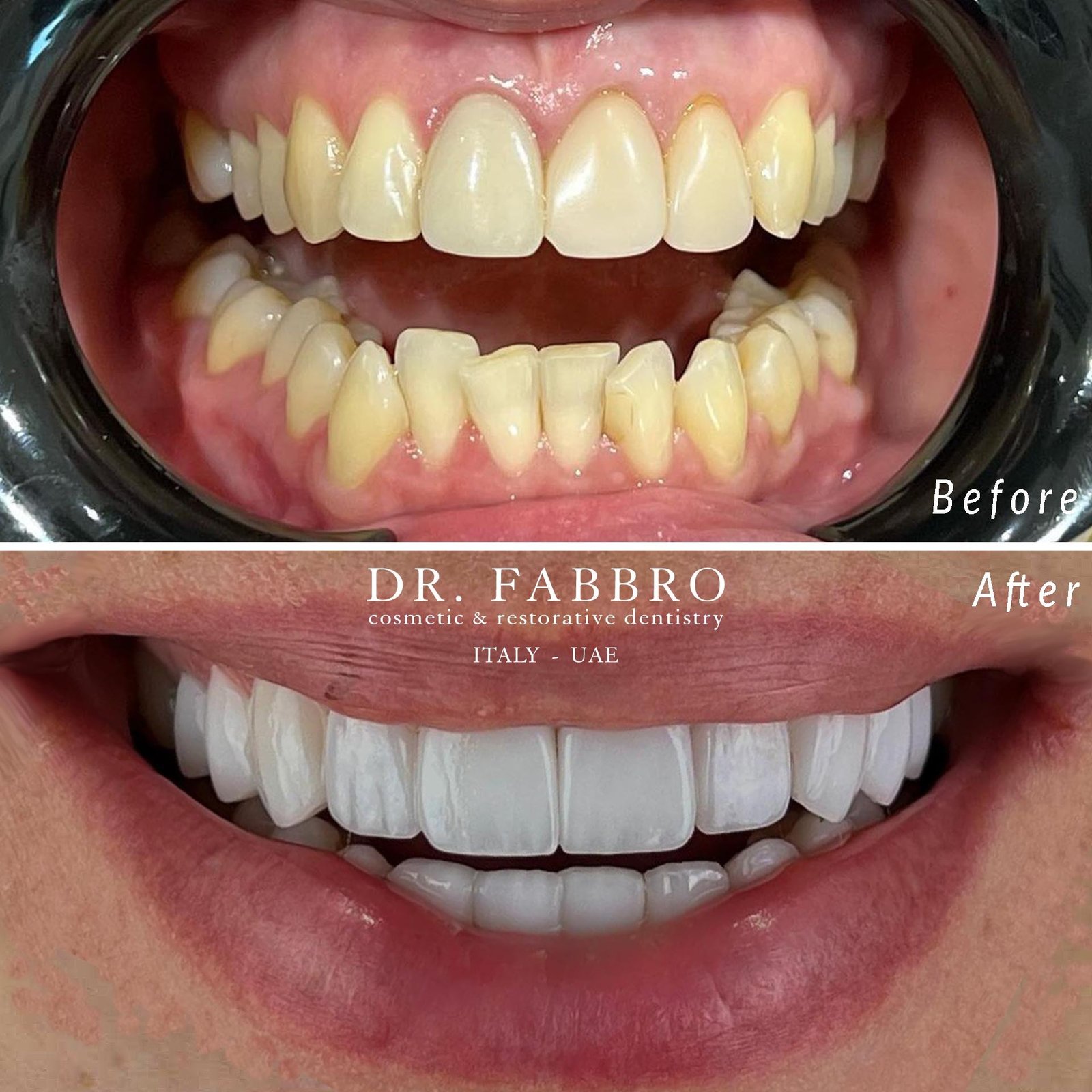 Ceramic veneers before and after, Dubai, case 2