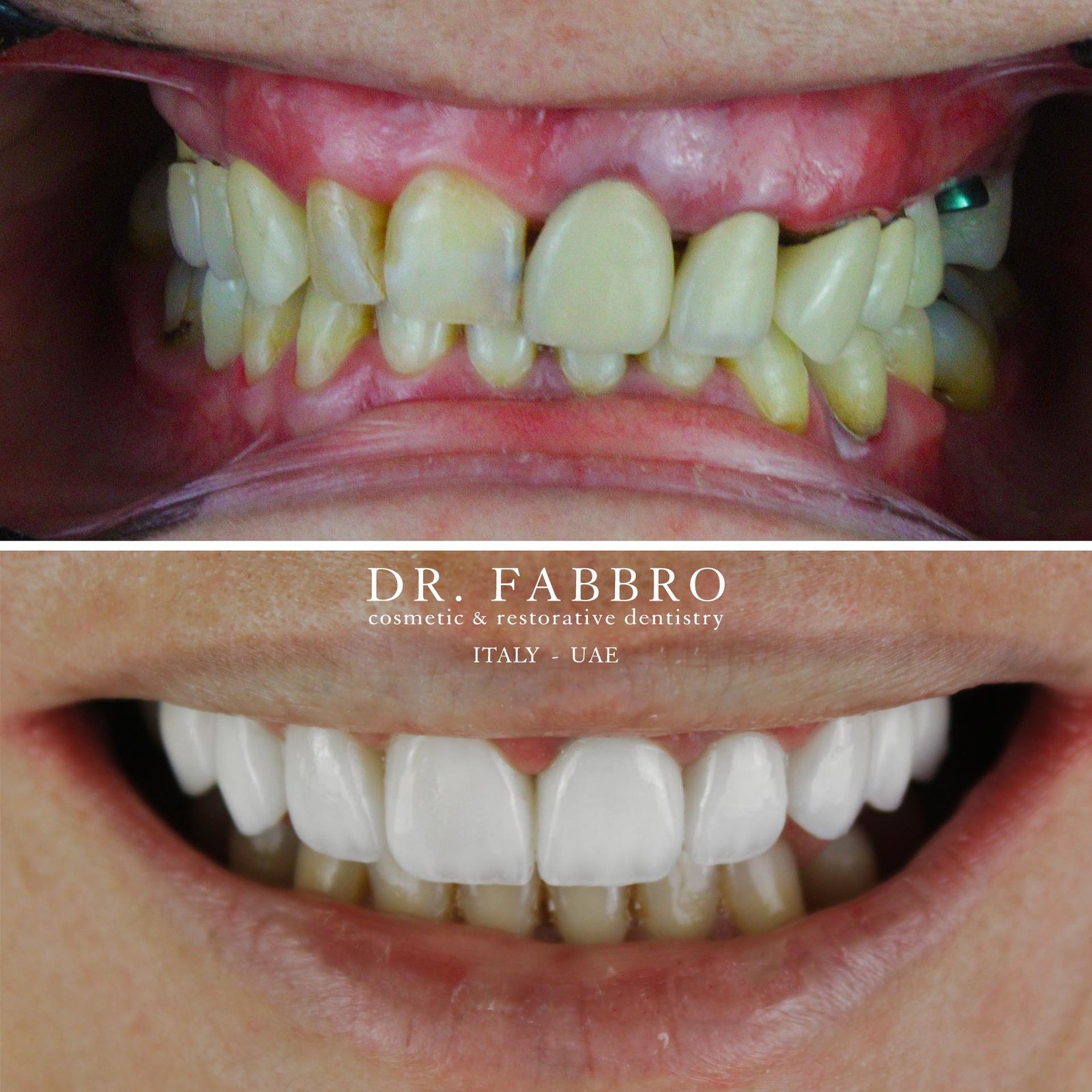 Ceramic veneers before and after, Dubai, case 3