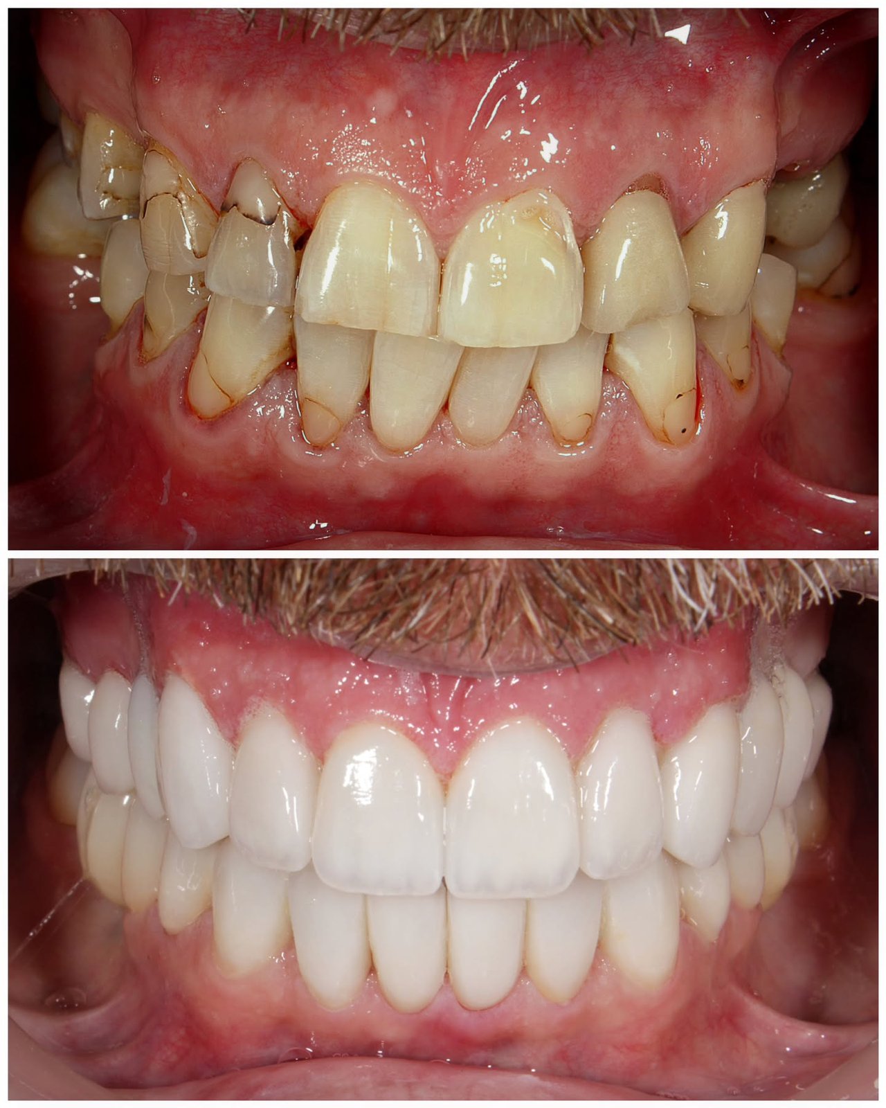 Ceramic veneers before and after, Dubai, case 6