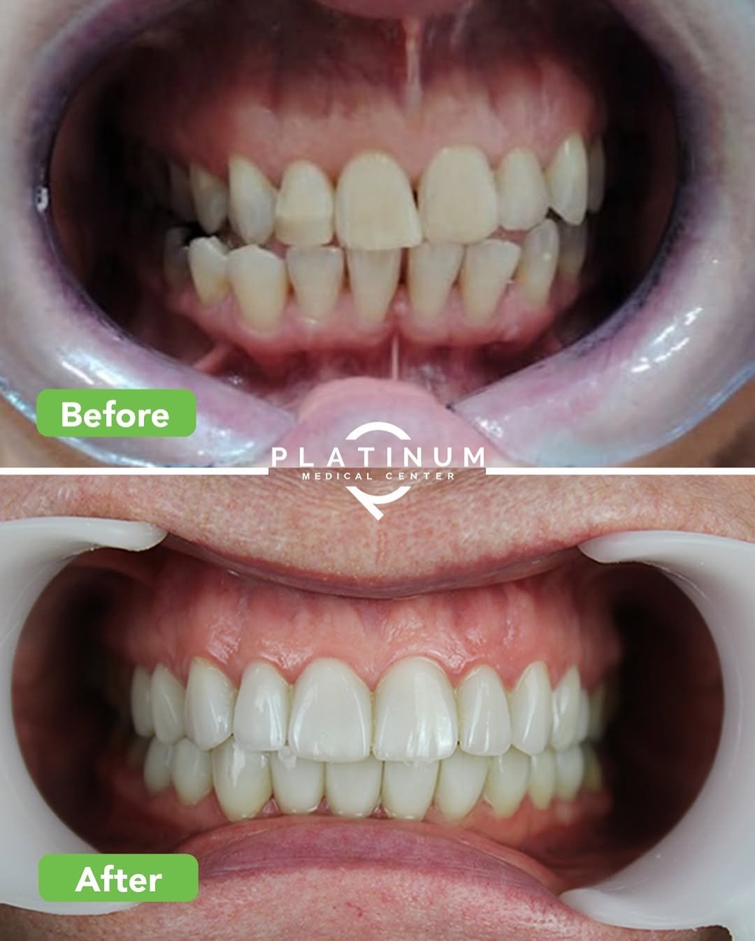 Ceramic veneers before and after, Dubai, case 9