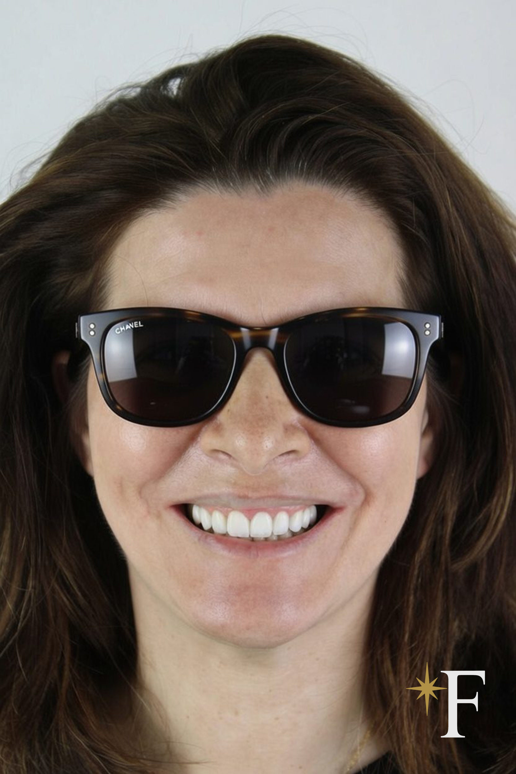 After cosmetic dentistry treatment in Dubai, a natural veneers result