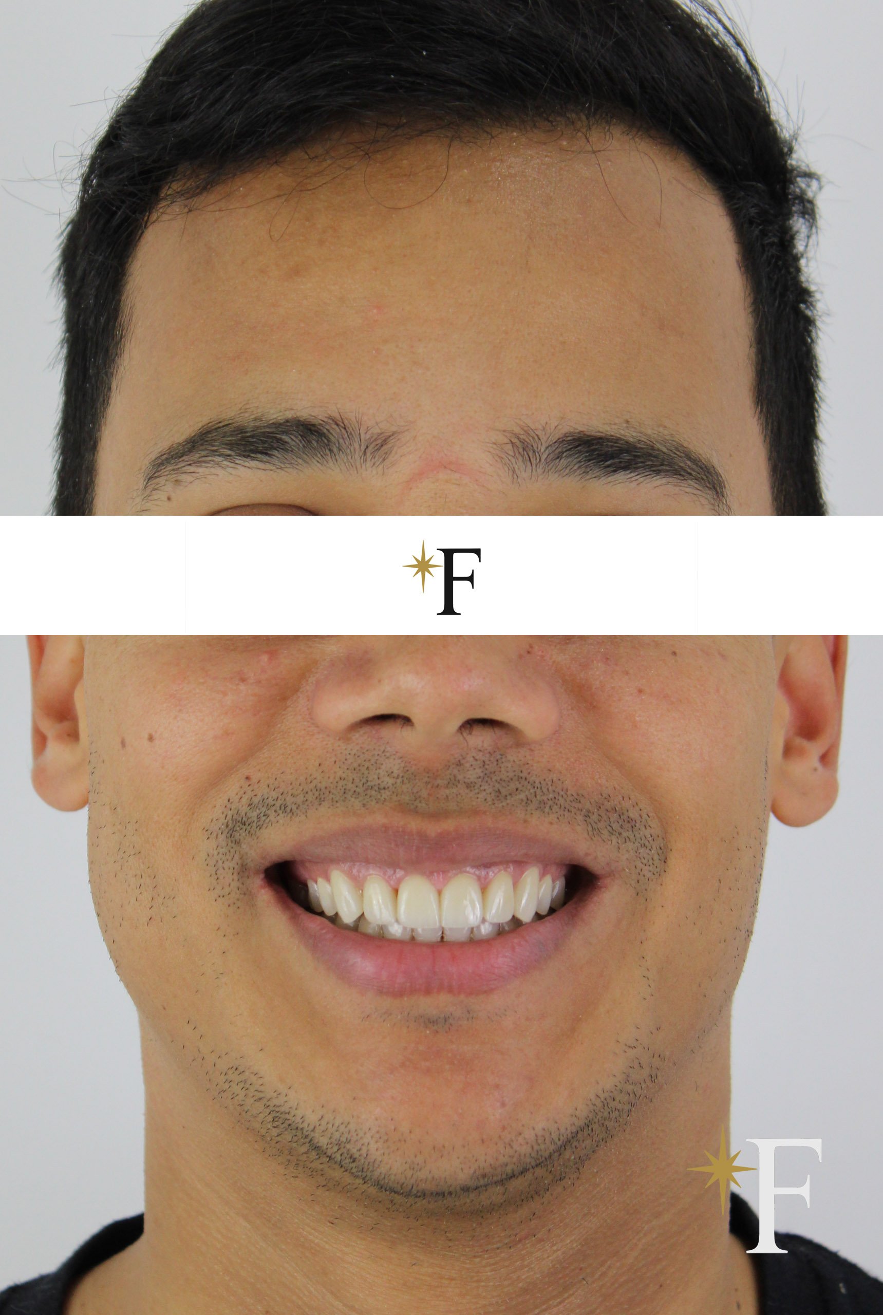 After veneers in Dubai, case 2, full face, same lens and position
