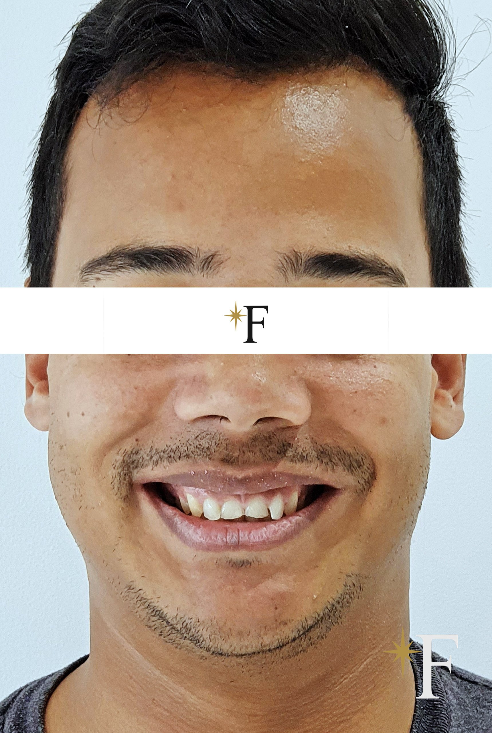 Before veneers in Dubai, case 2, full face, same lens and position
