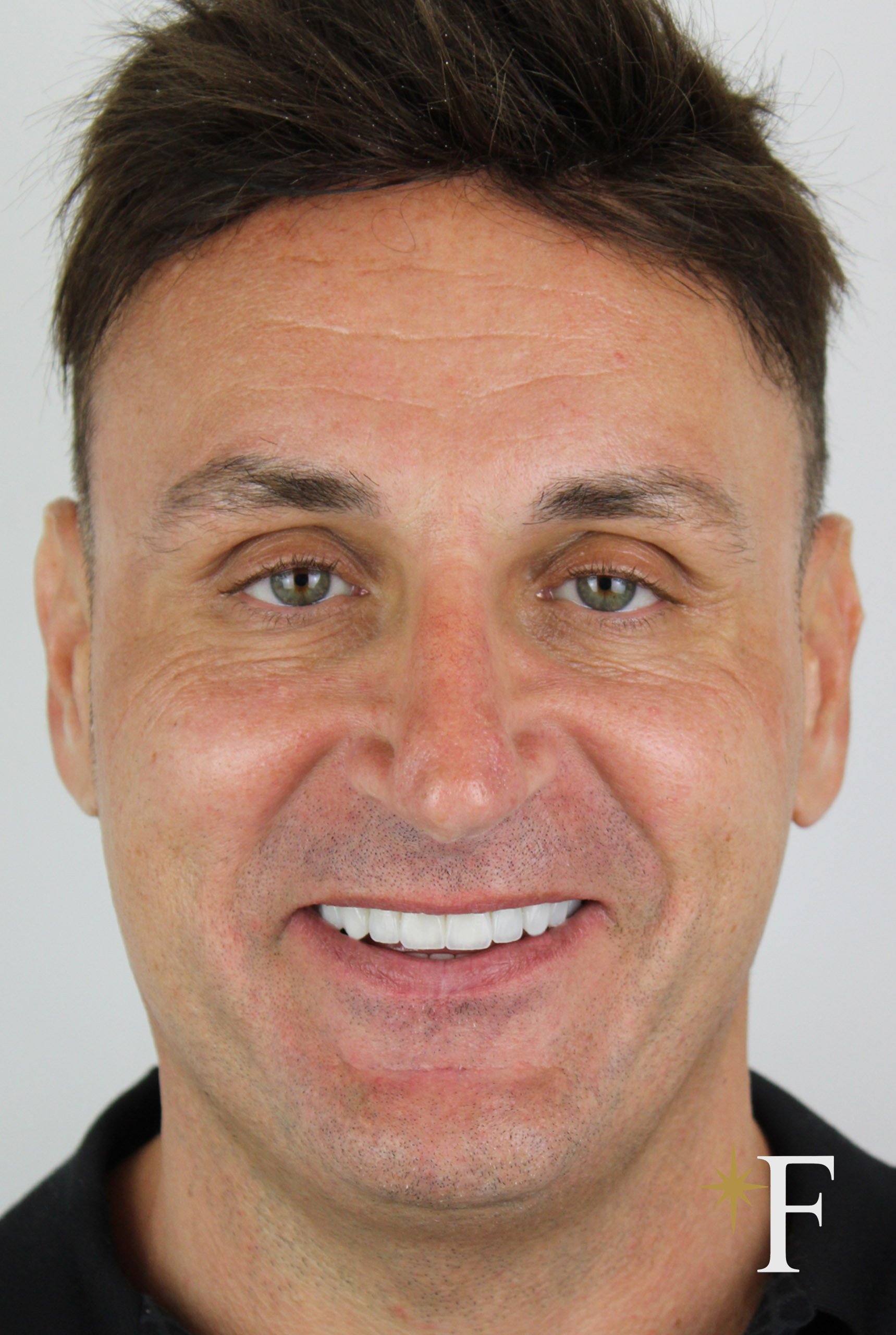 After veneers in Dubai, case 3, full face, same lens and position