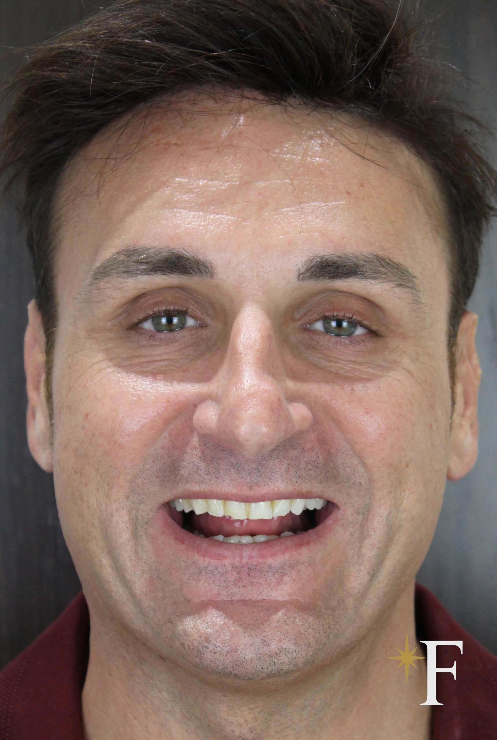 Before veneers in Dubai, case 3, full face, same lens and position