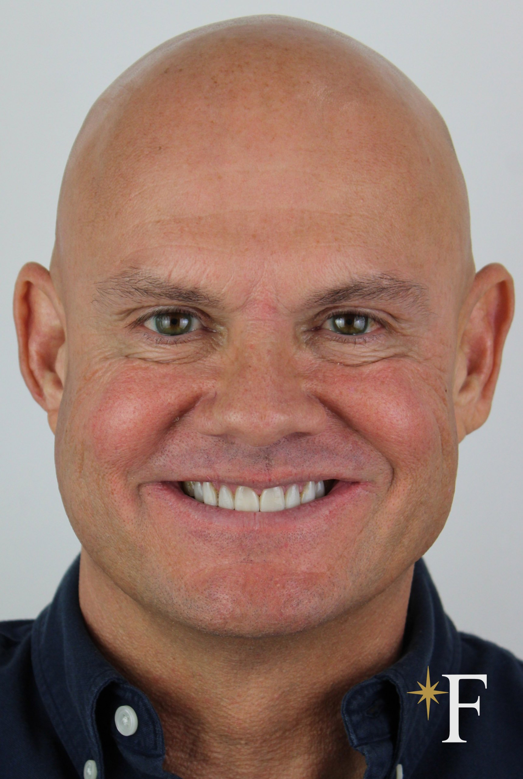 Before veneers in Dubai, case 4, full face, same lens and position