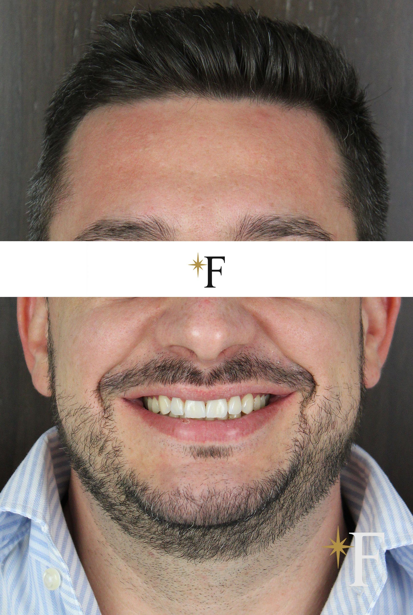 After veneers in Dubai, case 5, full face, same lens and position