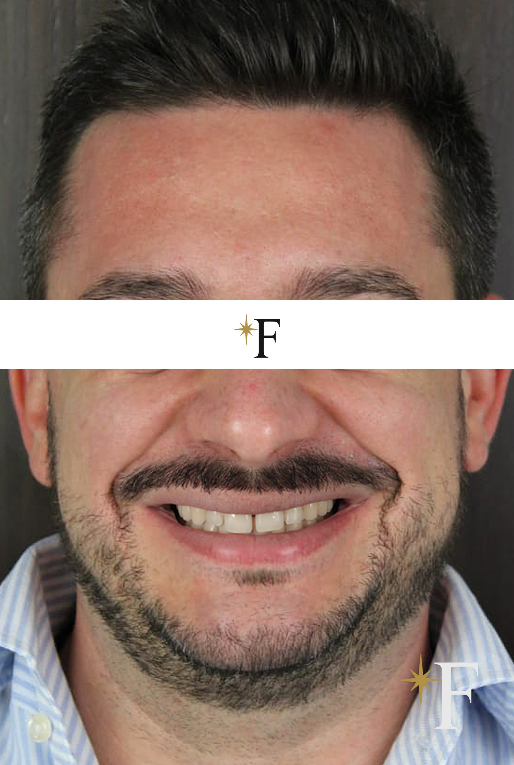 Before veneers in Dubai, case 5, full face, same lens and position