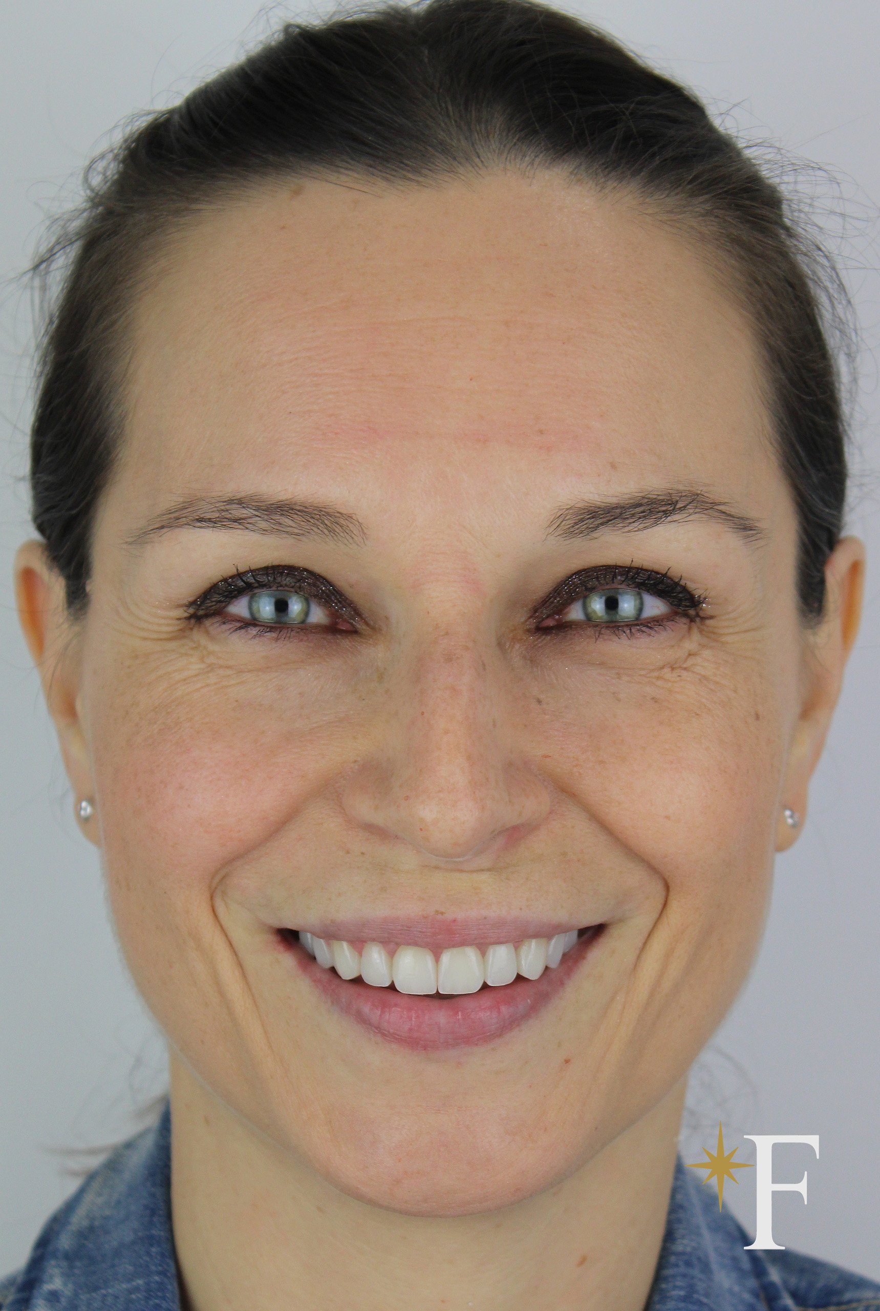 After veneers in Dubai, case 1, full face, same lens and position