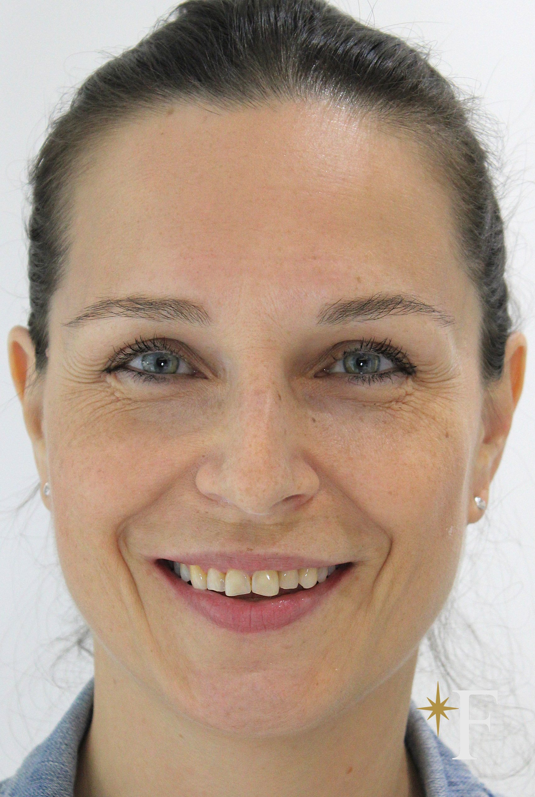 Before veneers in Dubai, case 1, full face, same lens and position