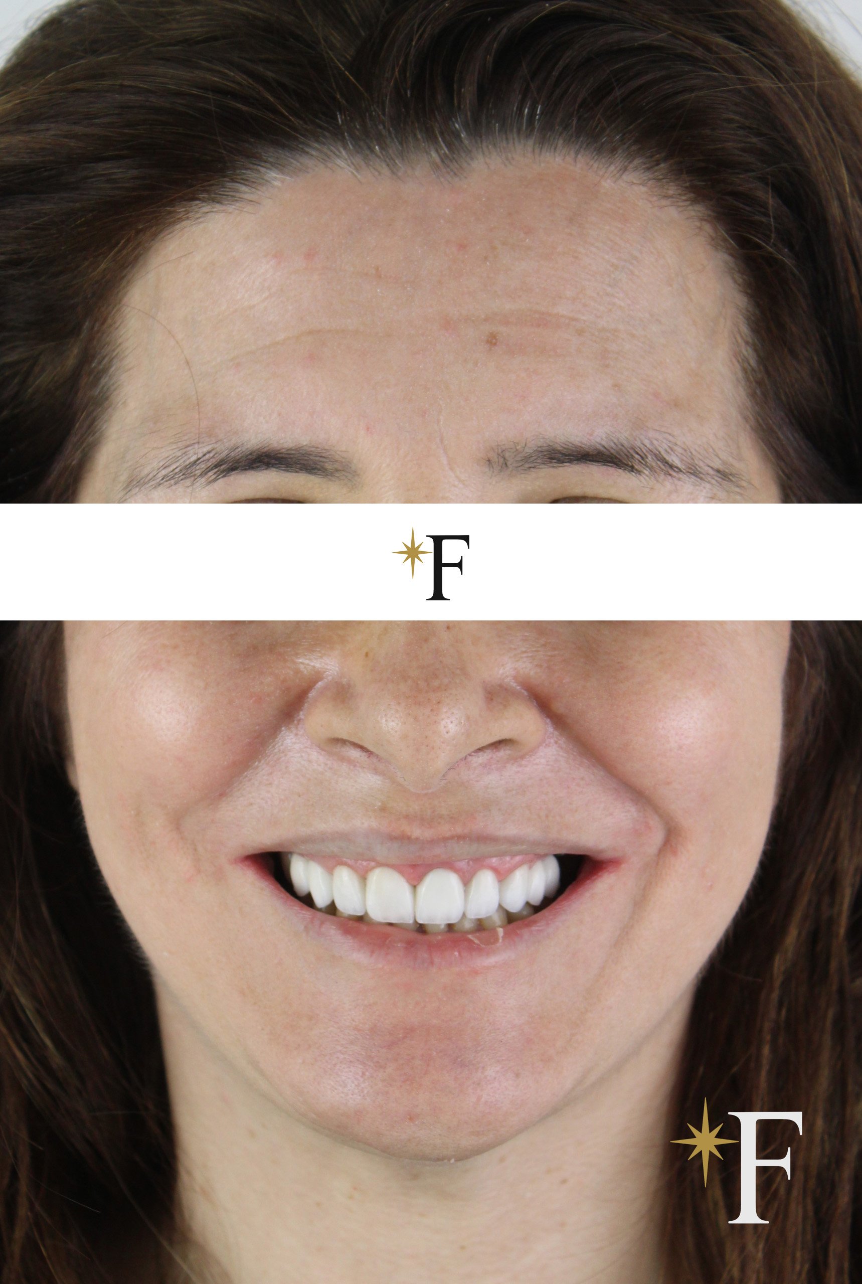After veneers in Dubai, case 6, full face, same lens and position