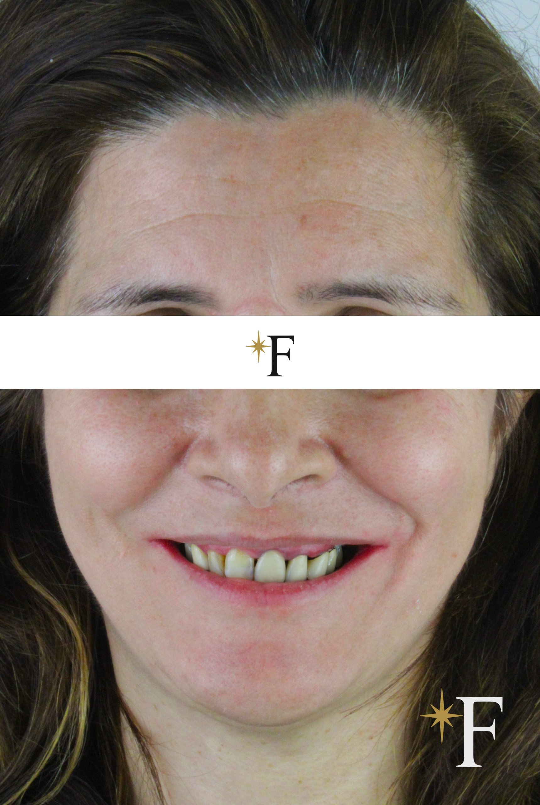 Before veneers in Dubai, case 6, full face, same lens and position