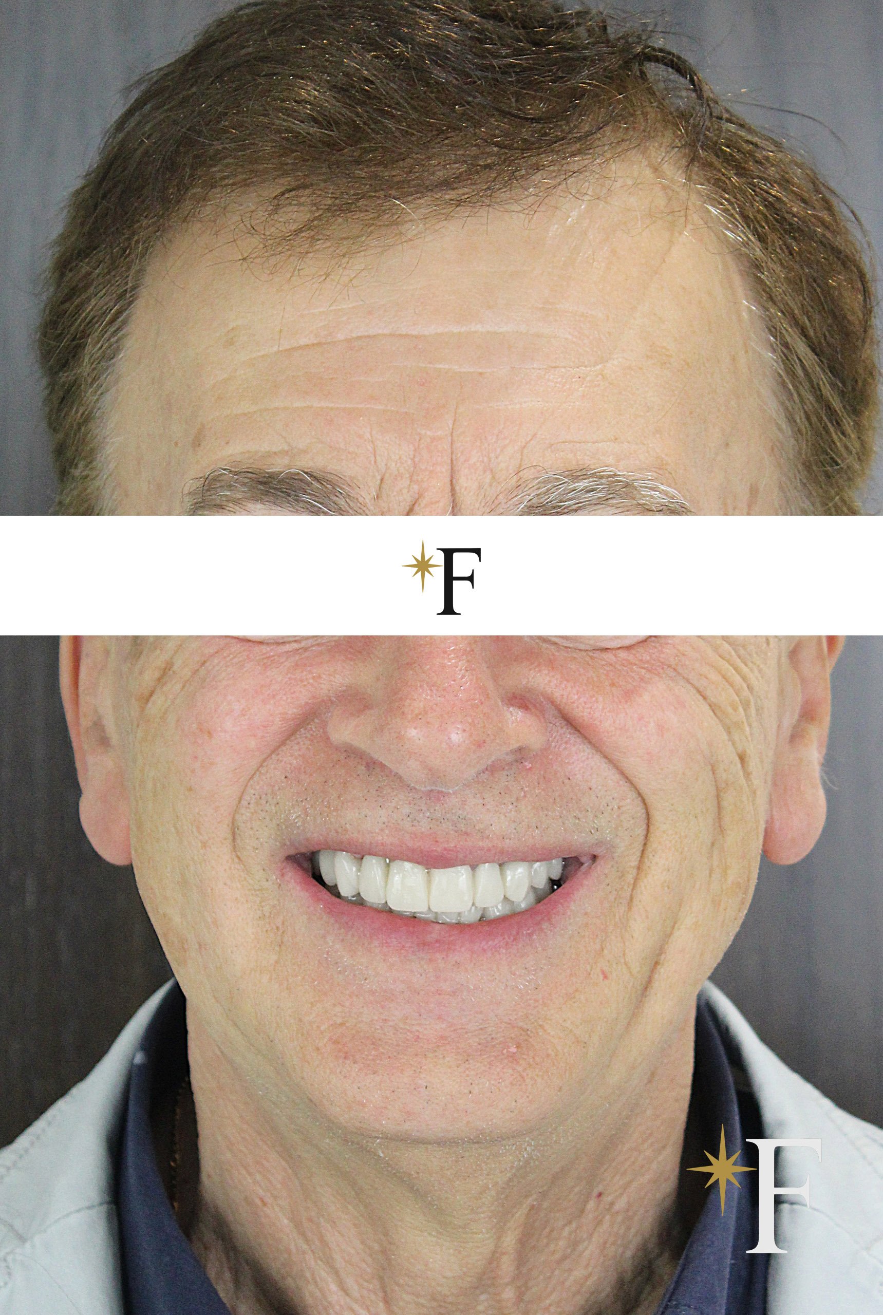 After veneers in Dubai, case 7, full face, same lens and position