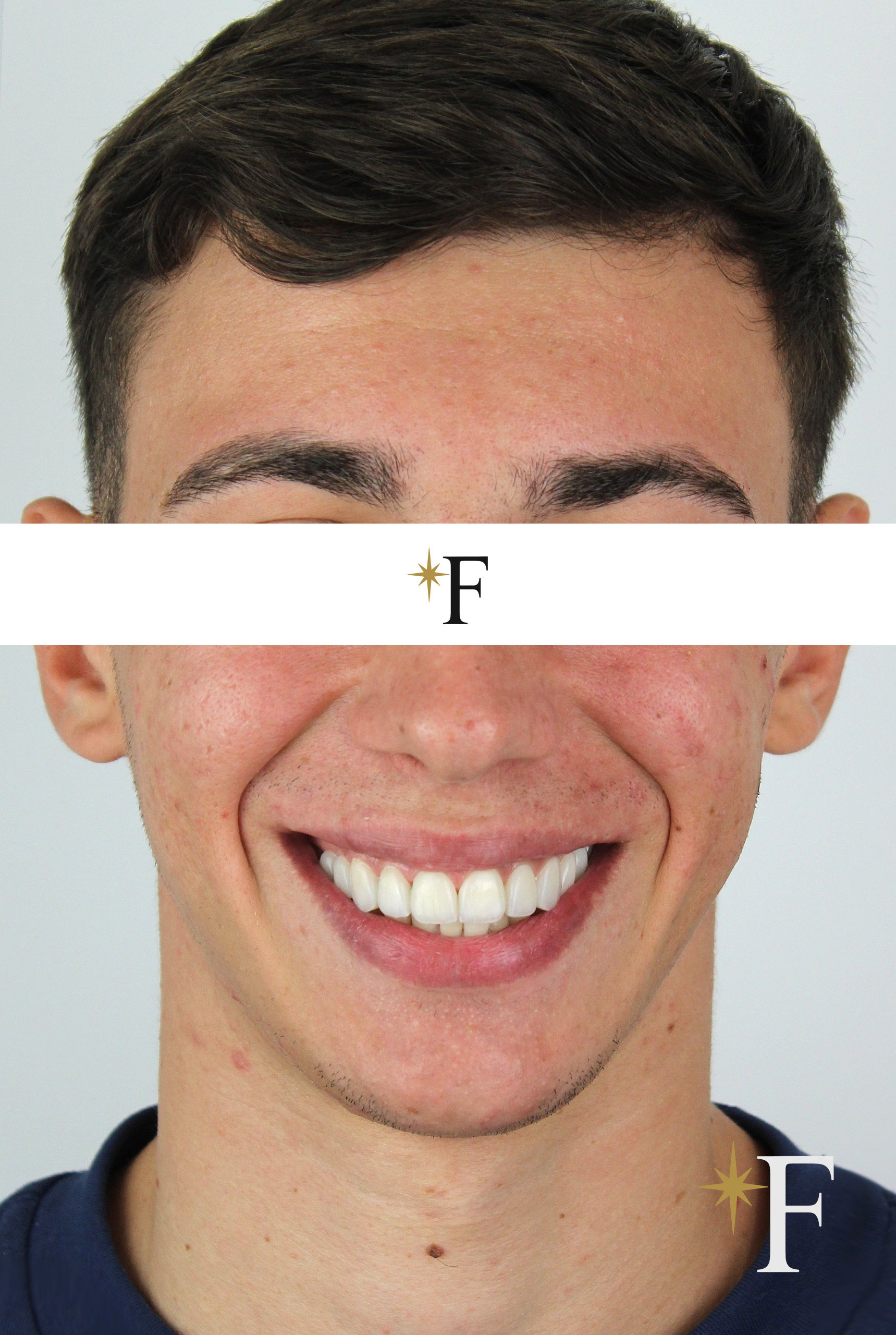 After veneers in Dubai, case 8, full face, same lens and position