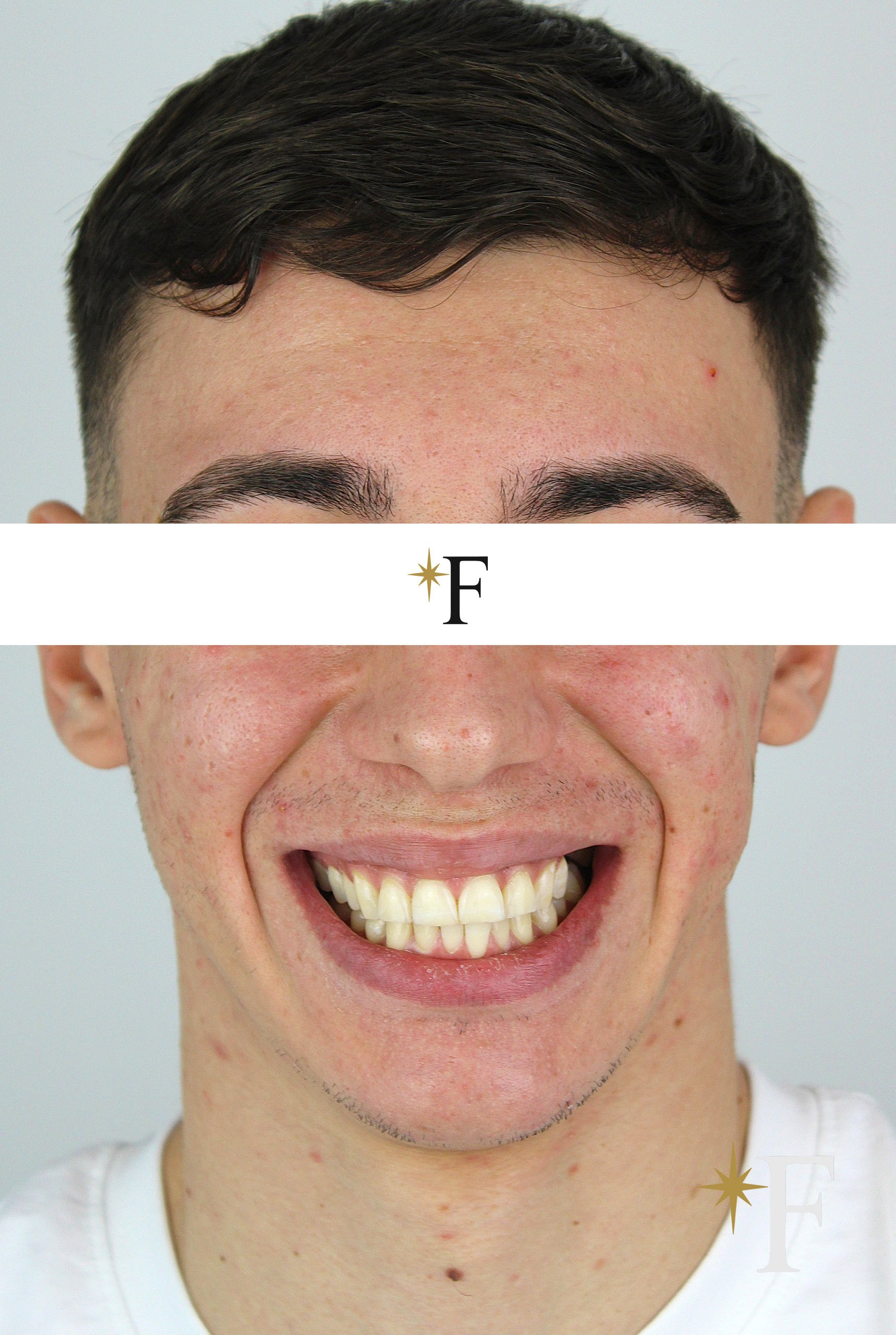 Before veneers in Dubai, case 8, full face, same lens and position