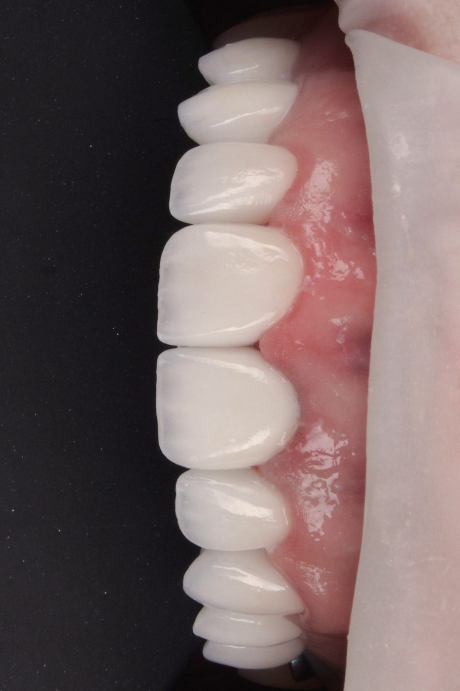 Placement, the porcelain-veneer process