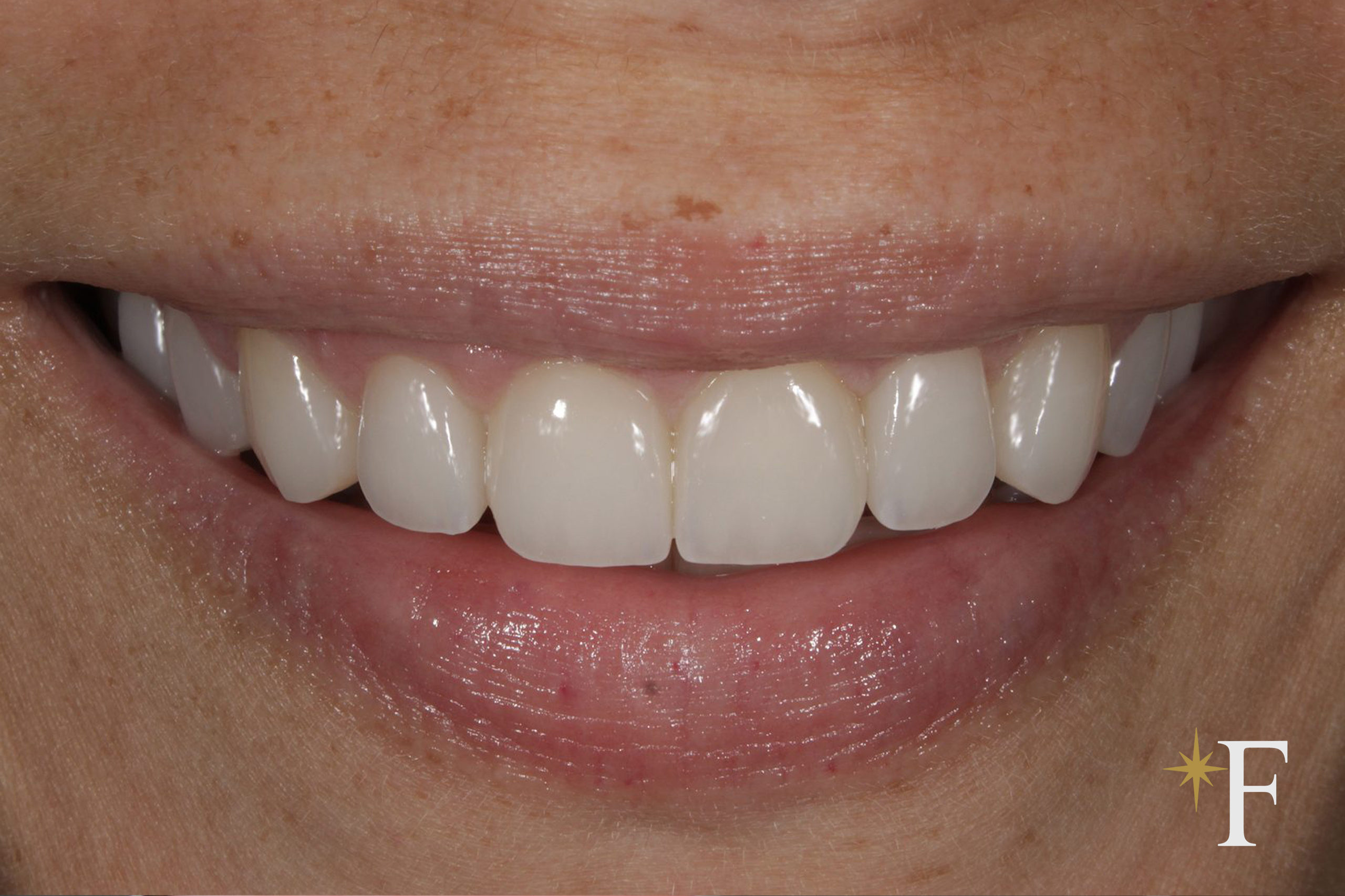 After porcelain veneers in Dubai, a natural result, not Hollywood white