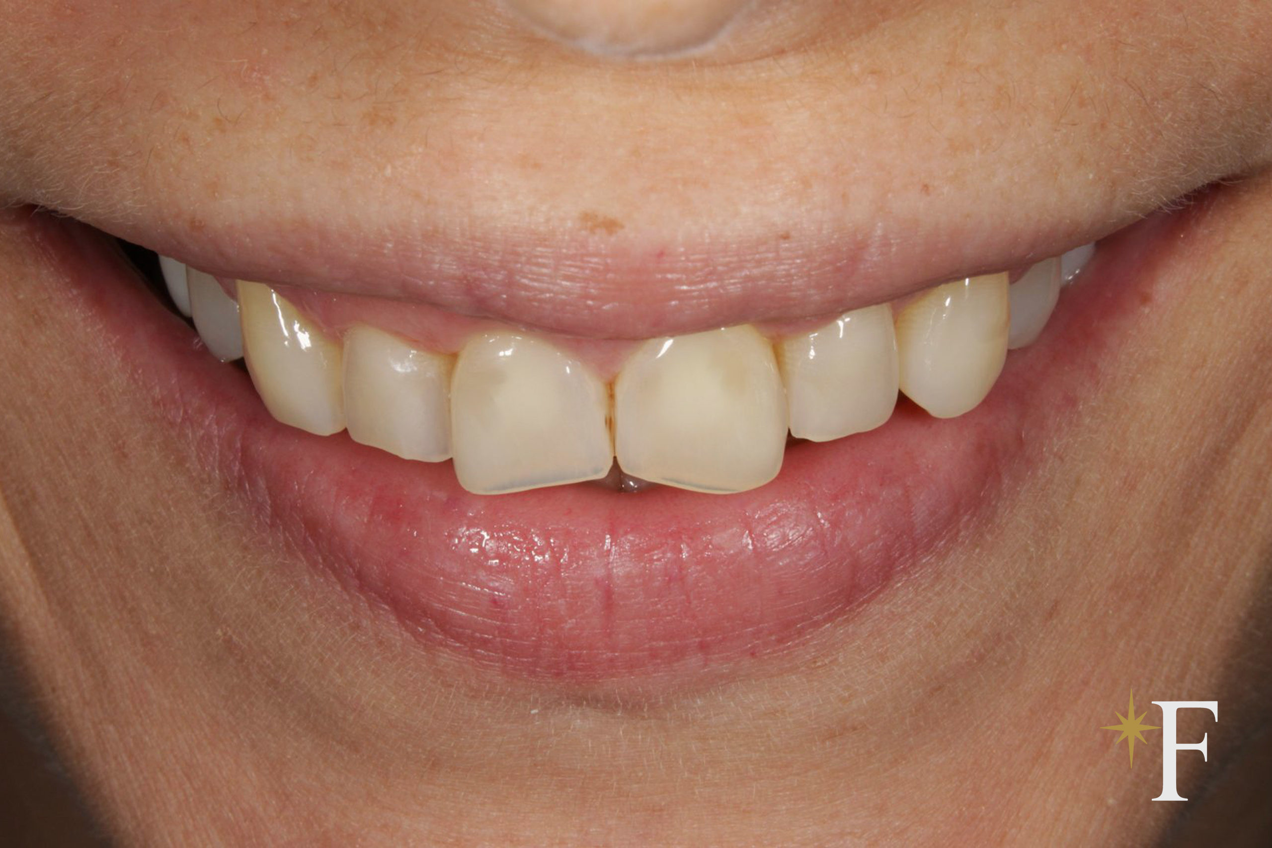 Before porcelain veneers, photographed with the same lens and position